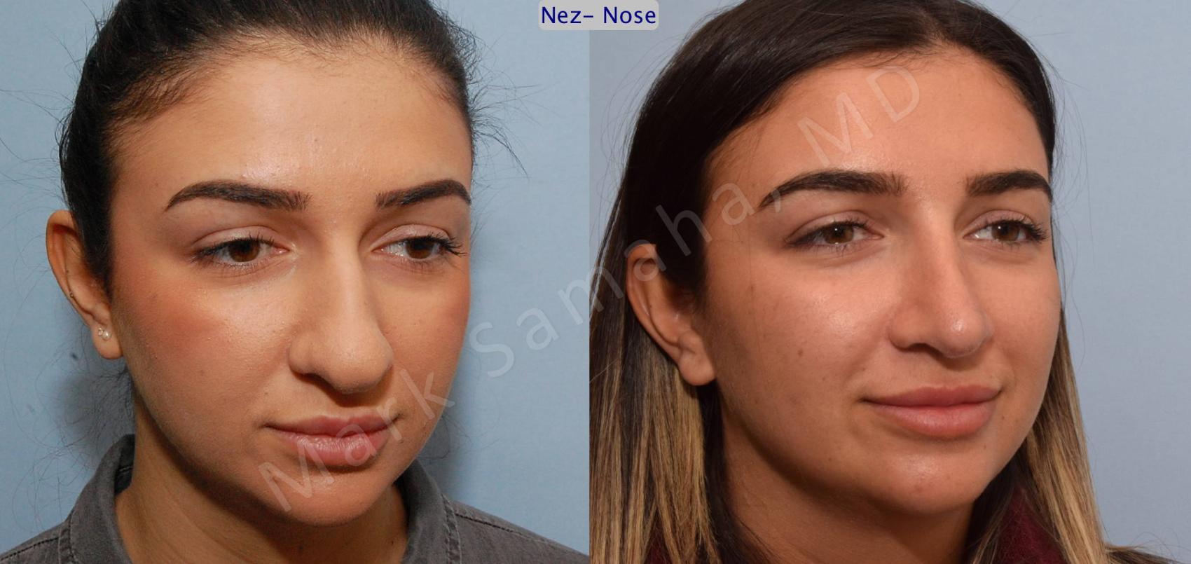 Before & After Rhinoplastie / Rhinoplasty Case 82 View #4 View in Montreal, QC