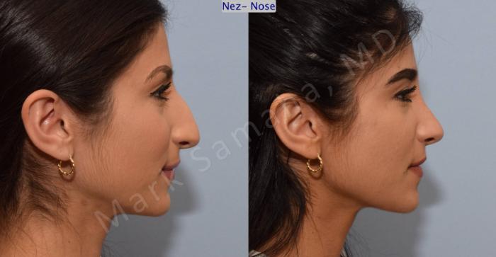 Before & After Rhinoplastie / Rhinoplasty Case 83 View #2 View in Montreal, QC
