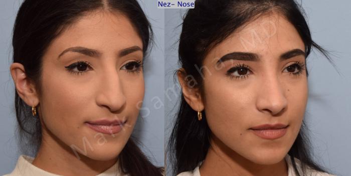 Before & After Rhinoplastie / Rhinoplasty Case 83 View #4 View in Montreal, QC