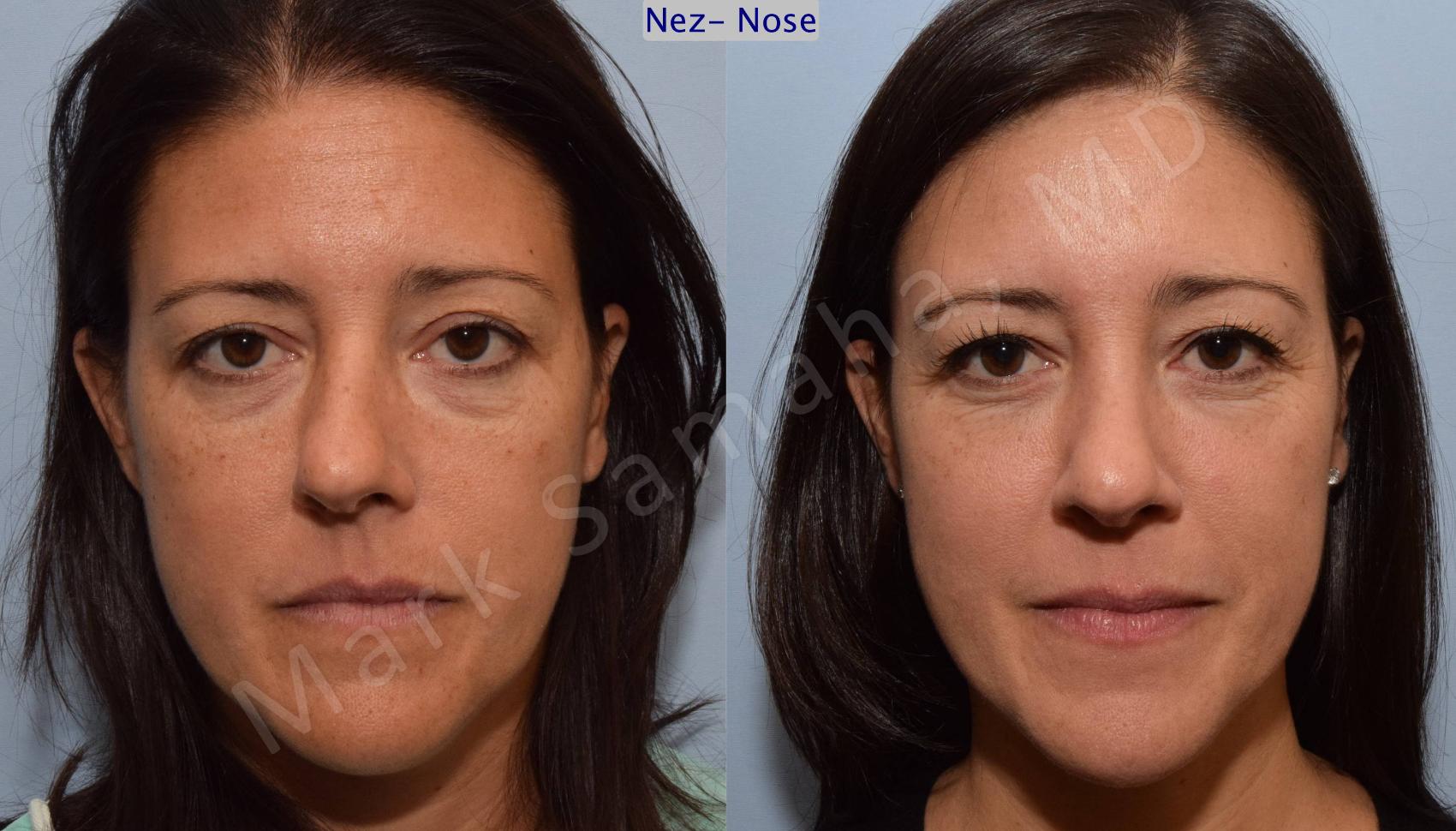Before & After Rhinoplastie / Rhinoplasty Case 93 View #1 View in Montreal, QC