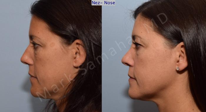 Before & After Rhinoplastie / Rhinoplasty Case 93 View #2 View in Mount Royal, QC