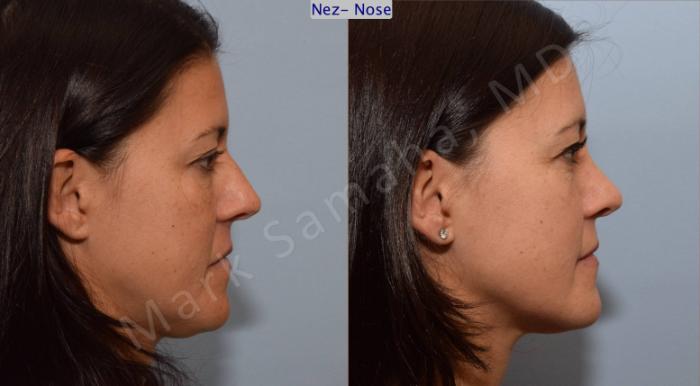 Before & After Rhinoplastie / Rhinoplasty Case 93 View #3 View in Montreal, QC