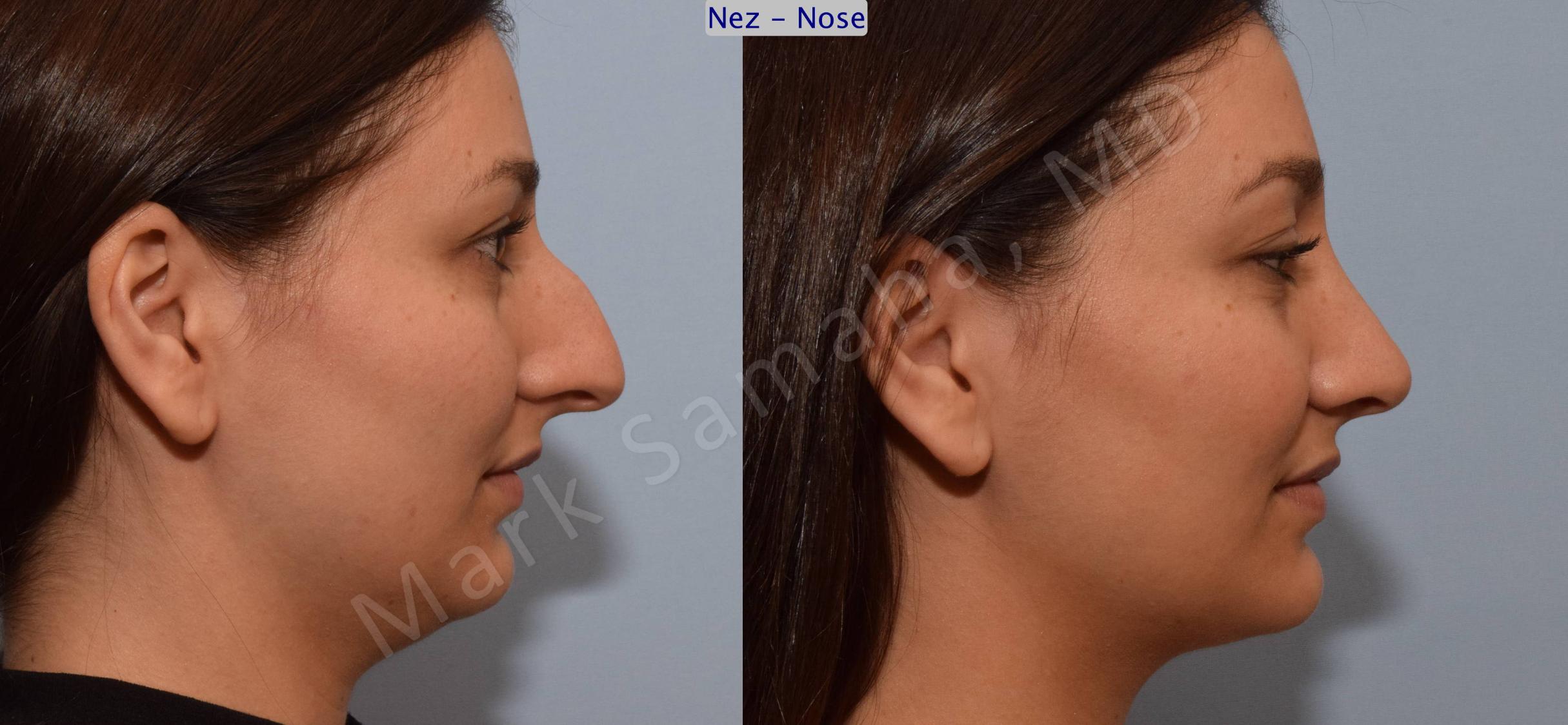 Before & After Rhinoplasty / Rhinoplastie Case 105 View #4 View in Mount Royal, QC