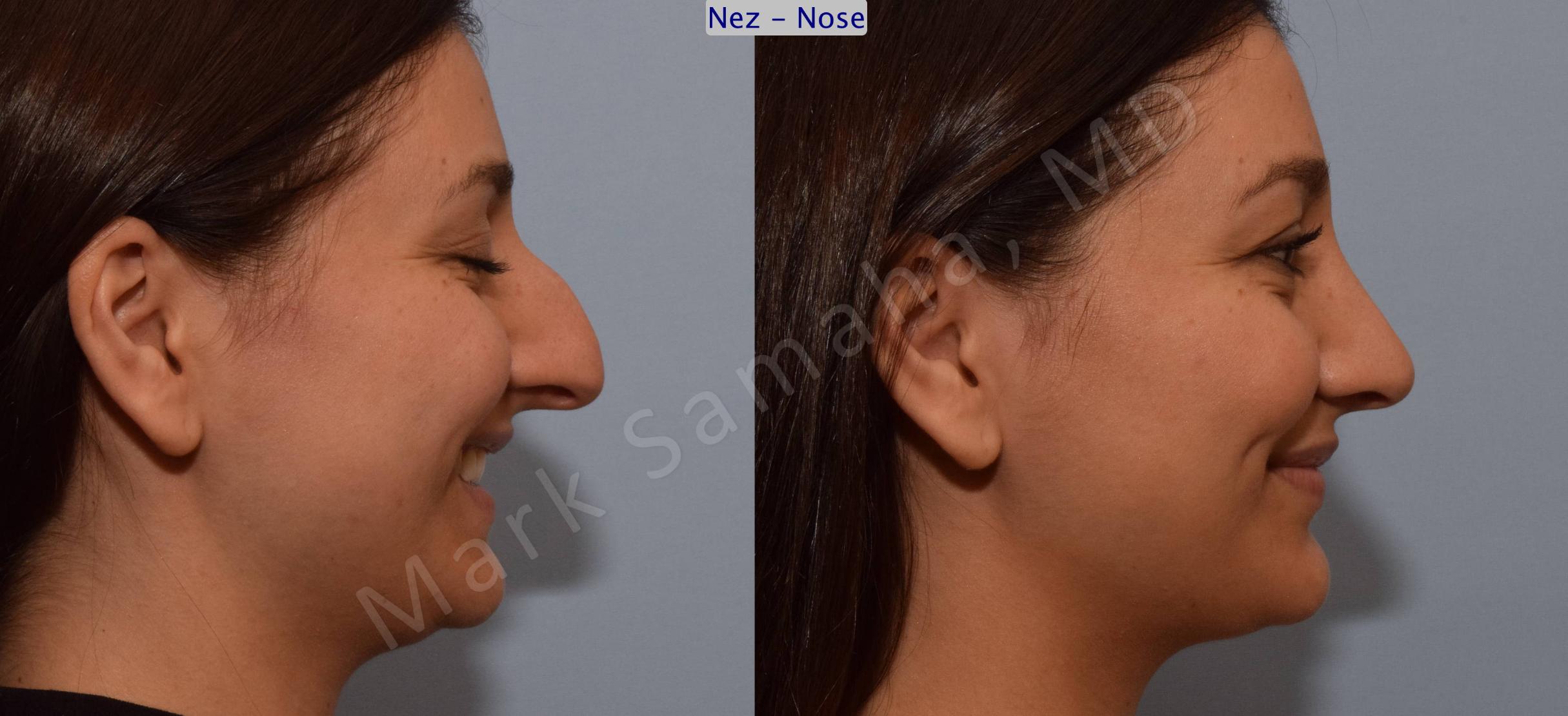 Before & After Rhinoplastie / Rhinoplasty Case 105 View #5 View in Mount Royal, QC