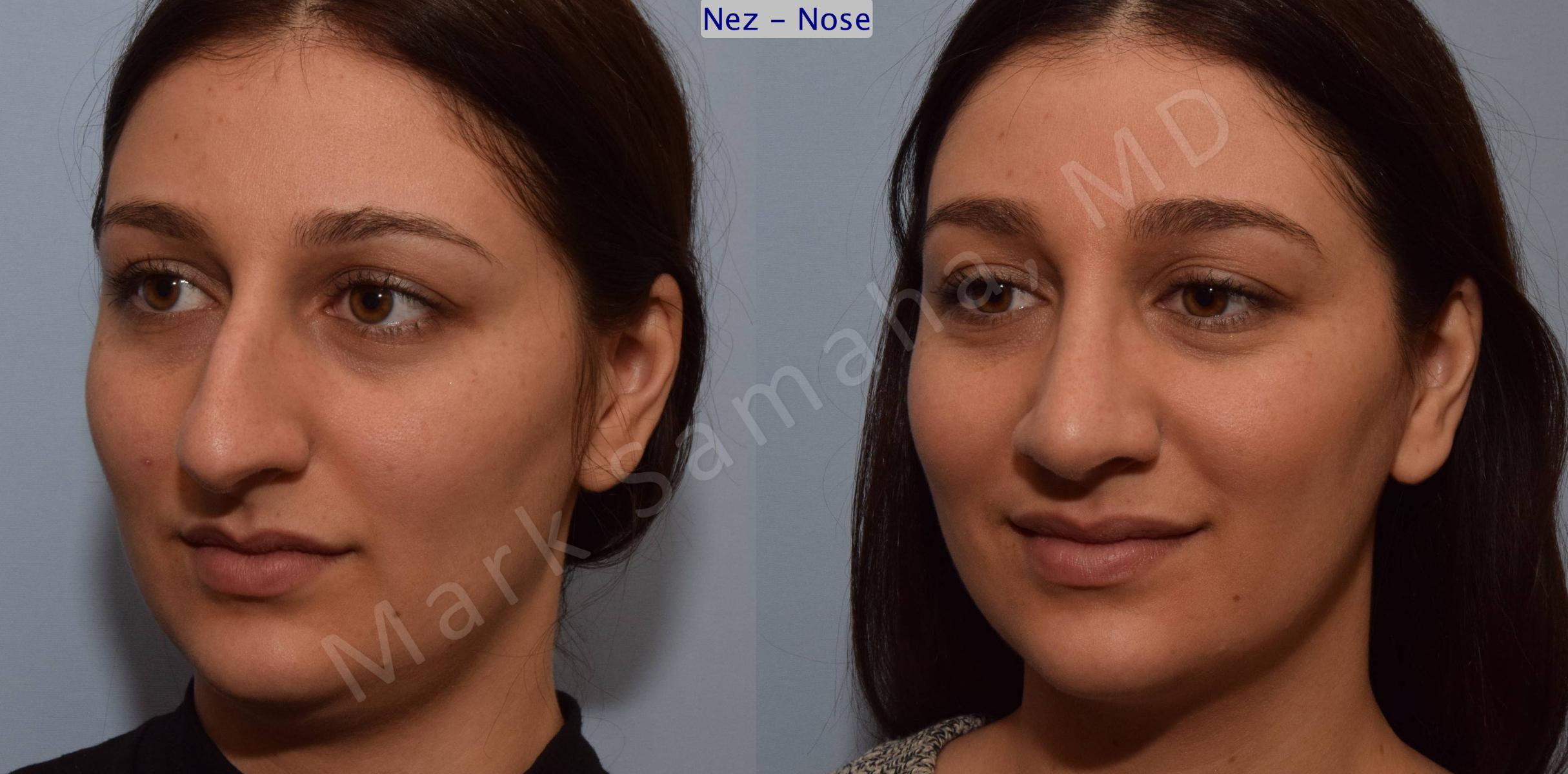 Before & After Rhinoplasty / Rhinoplastie Case 105 View #6 View in Mount Royal, QC
