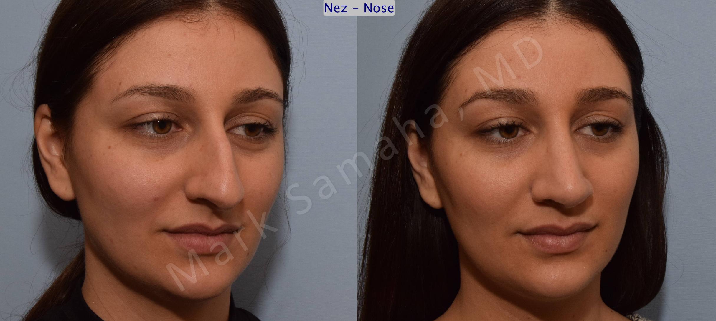 Before & After Rhinoplastie / Rhinoplasty Case 105 View #8 View in Mount Royal, QC