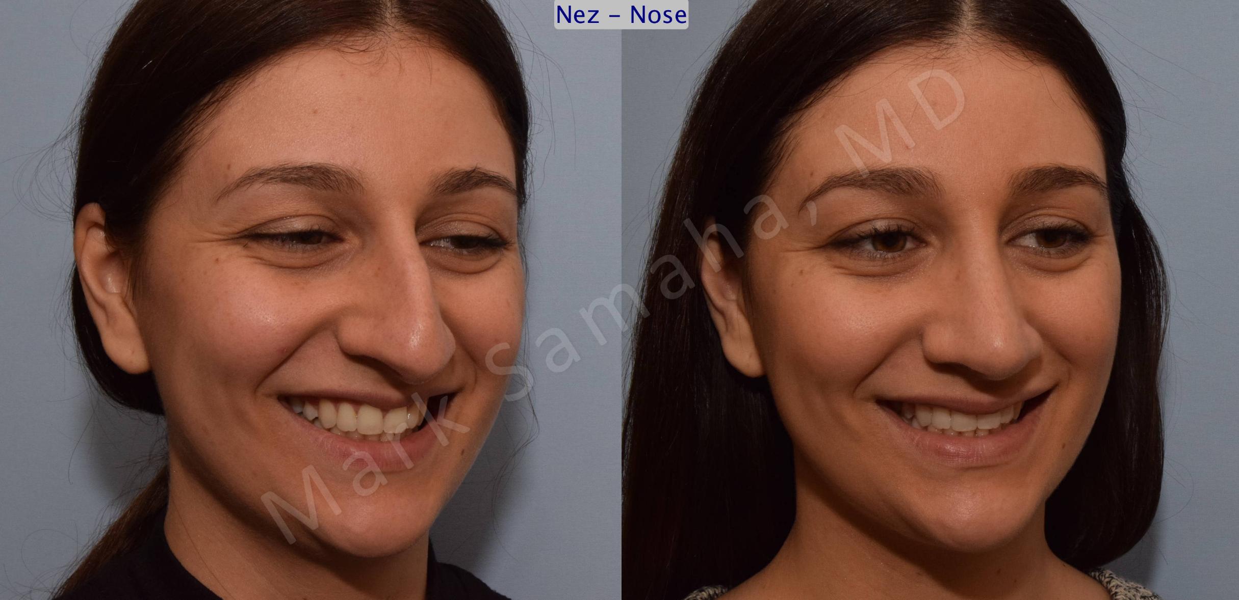 Before & After Rhinoplasty / Rhinoplastie Case 105 View #9 View in Mount Royal, QC