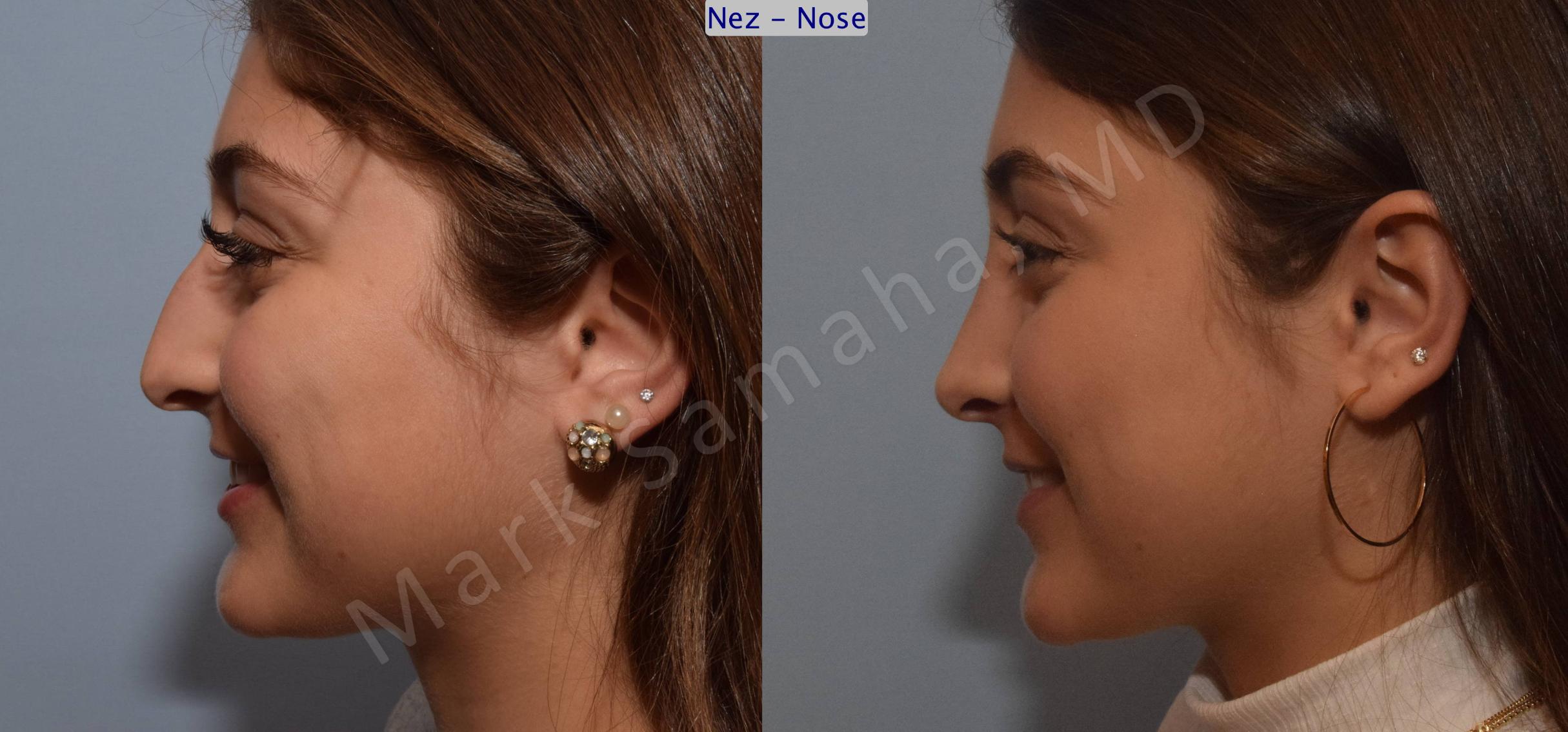 Before & After Rhinoplasty / Rhinoplastie Case 106 View #3 View in Mount Royal, QC
