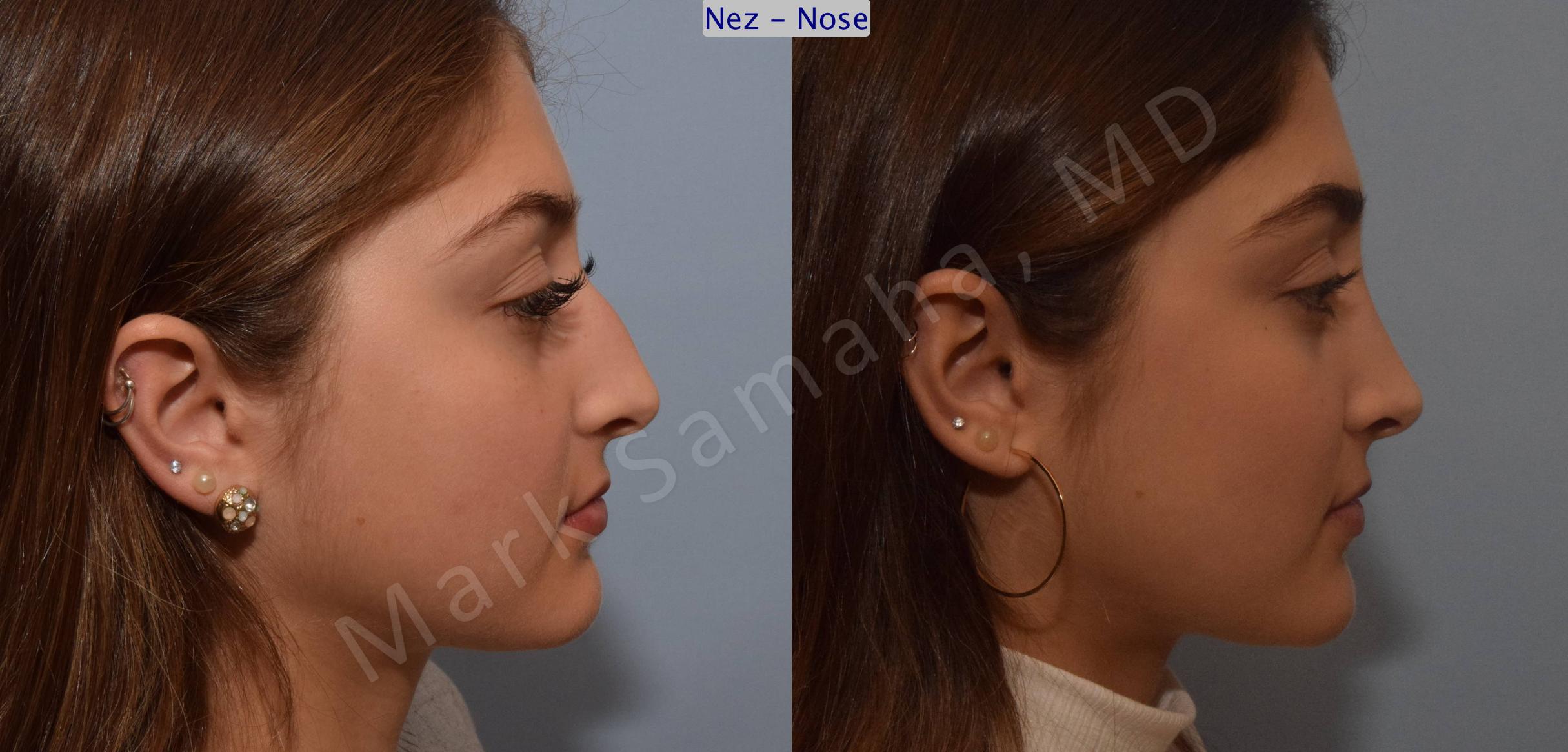 Before & After Rhinoplasty / Rhinoplastie Case 106 View #4 View in Mount Royal, QC