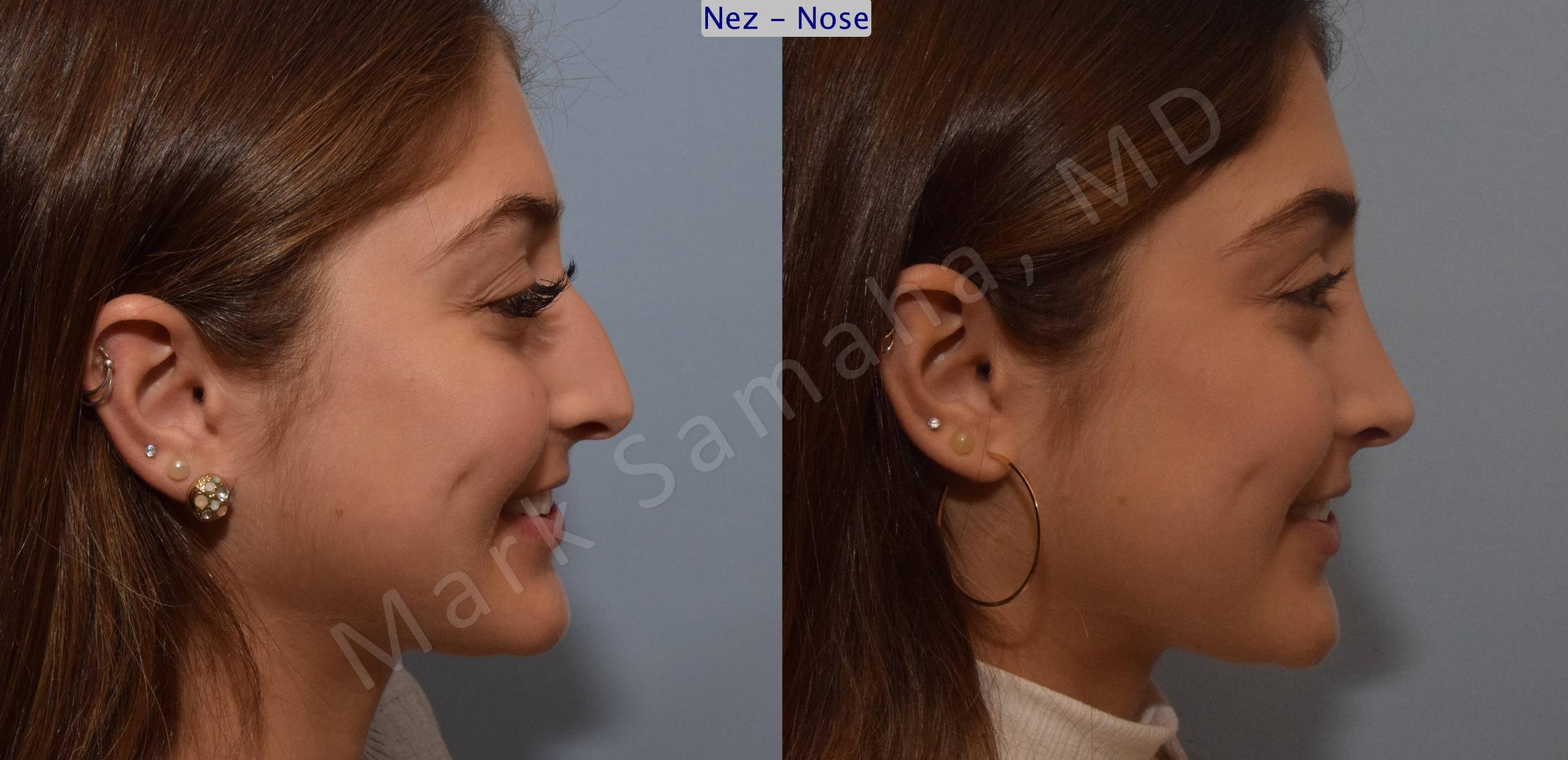 Before & After Rhinoplasty / Rhinoplastie Case 106 View #5 View in Mount Royal, QC