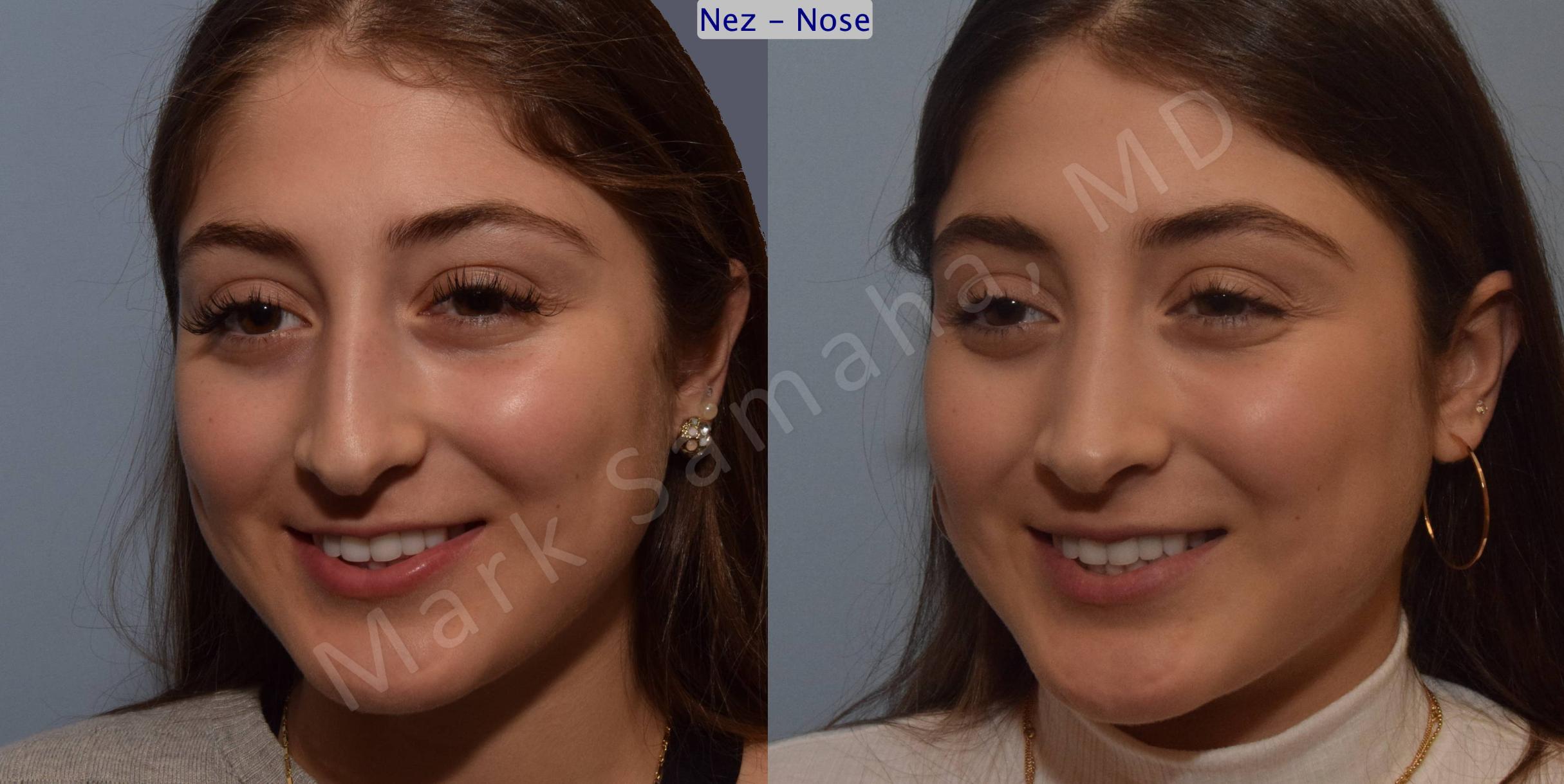 Before & After Rhinoplasty / Rhinoplastie Case 106 View #7 View in Mount Royal, QC