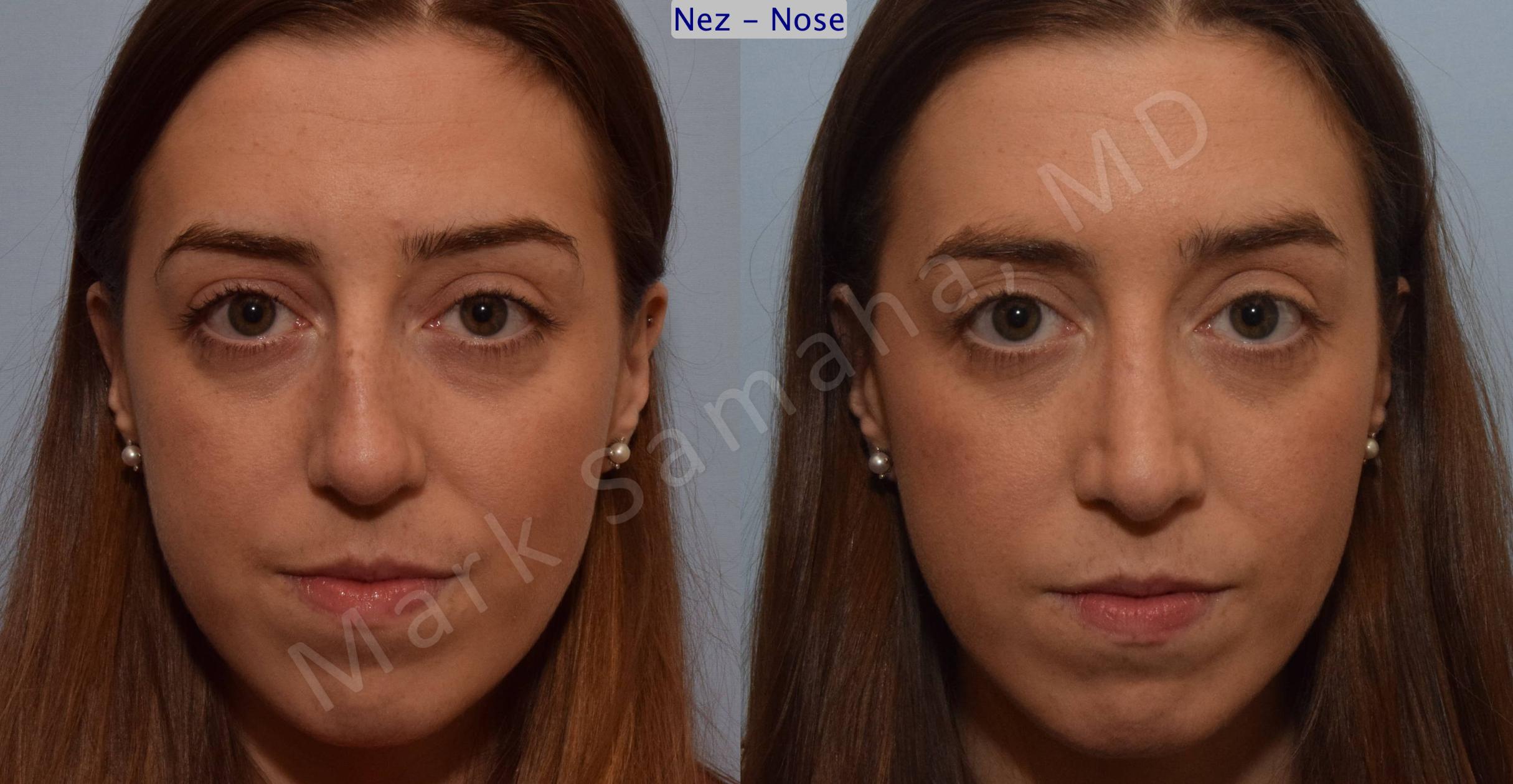 Before & After Rhinoplastie / Rhinoplasty Case 107 View #1 View in Mount Royal, QC