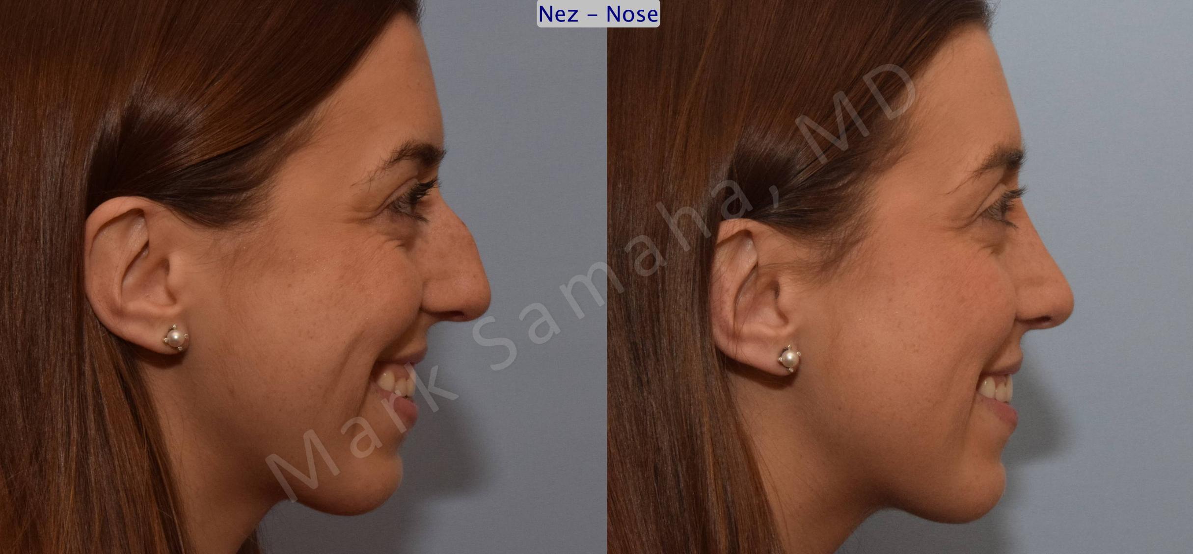 Before & After Rhinoplasty / Rhinoplastie Case 107 View #5 View in Mount Royal, QC