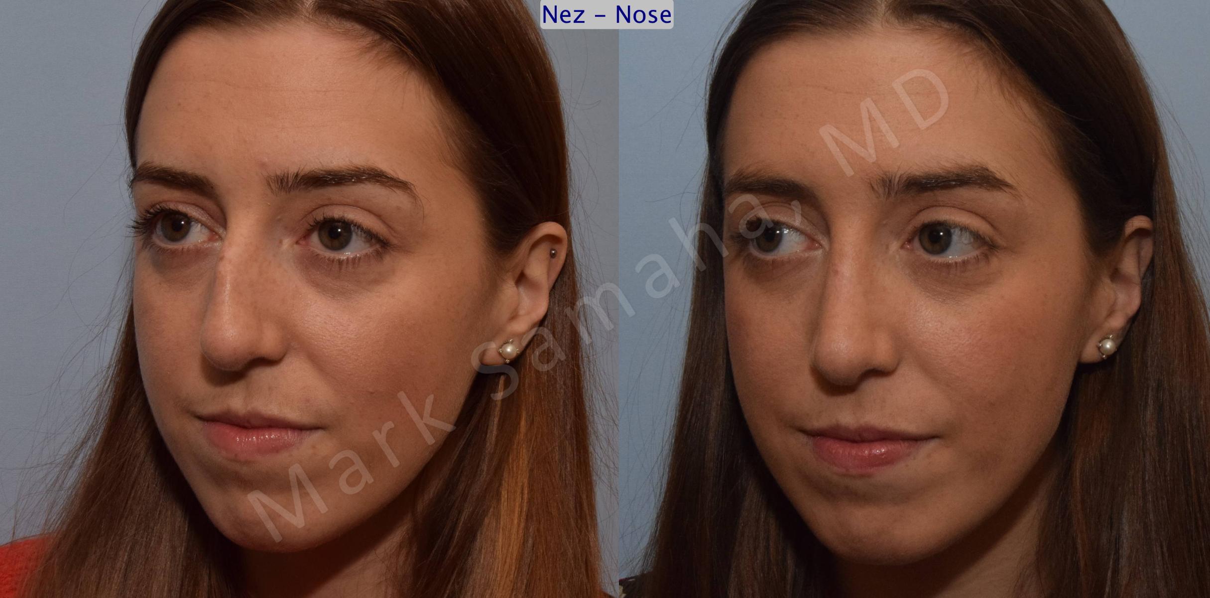 Before & After Rhinoplasty / Rhinoplastie Case 107 View #6 View in Mount Royal, QC