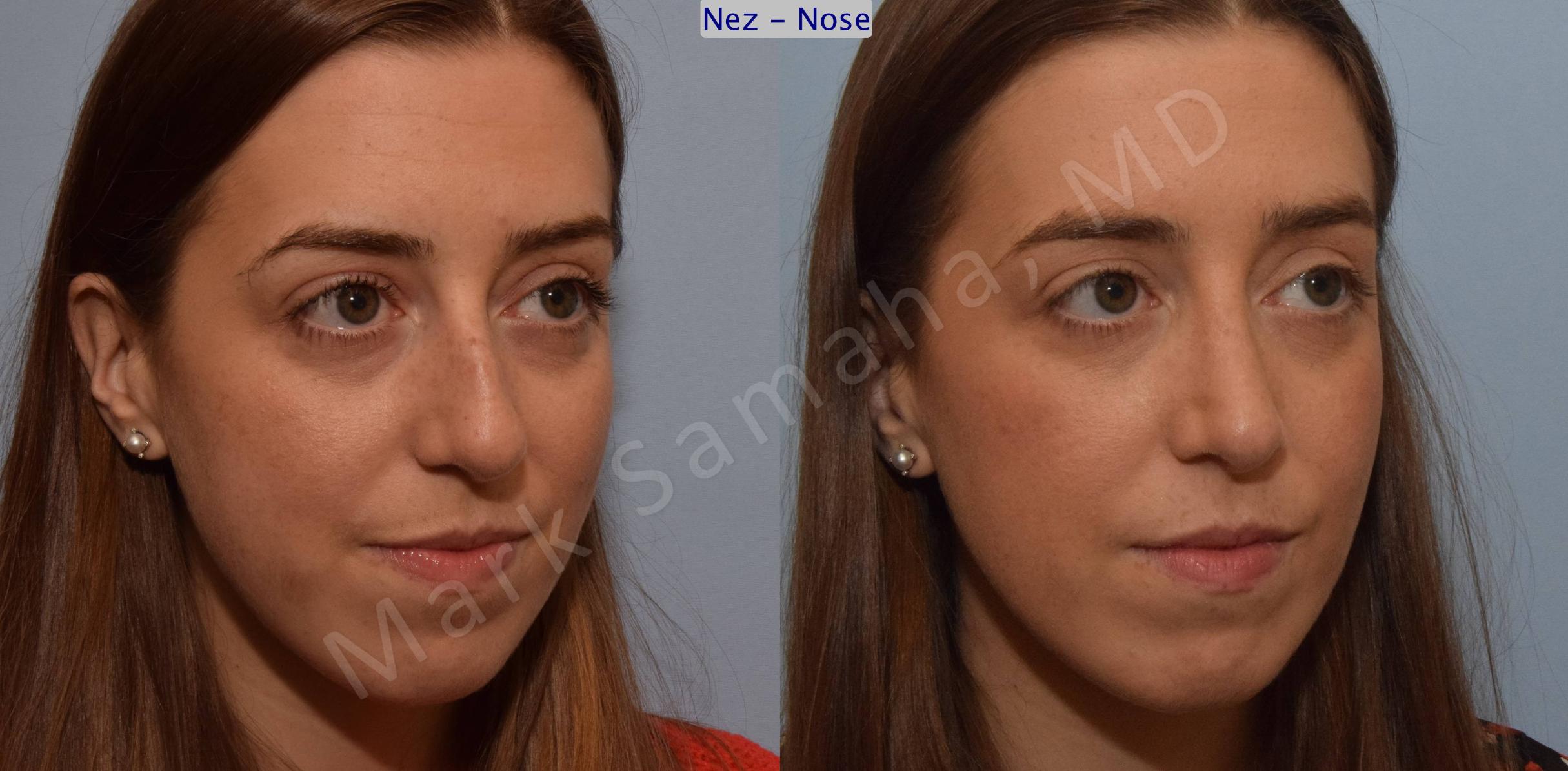 Before & After Rhinoplastie / Rhinoplasty Case 107 View #8 View in Mount Royal, QC
