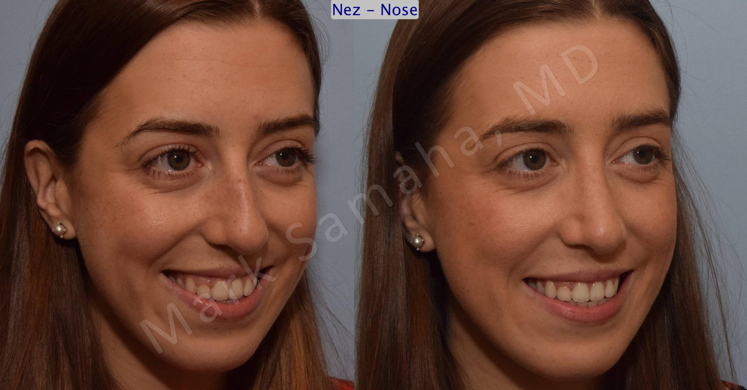 Before & After Rhinoplasty / Rhinoplastie Case 107 View #9 View in Mount Royal, QC