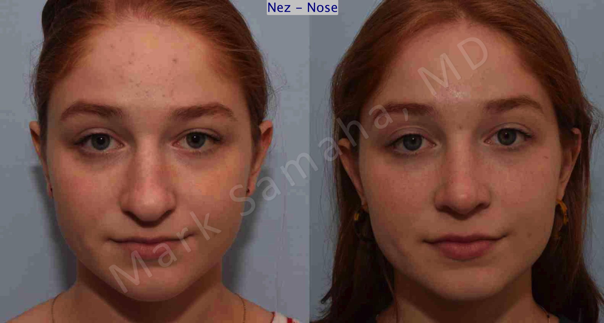Before & After Rhinoplasty / Rhinoplastie Case 108 View #1 View in Mount Royal, QC