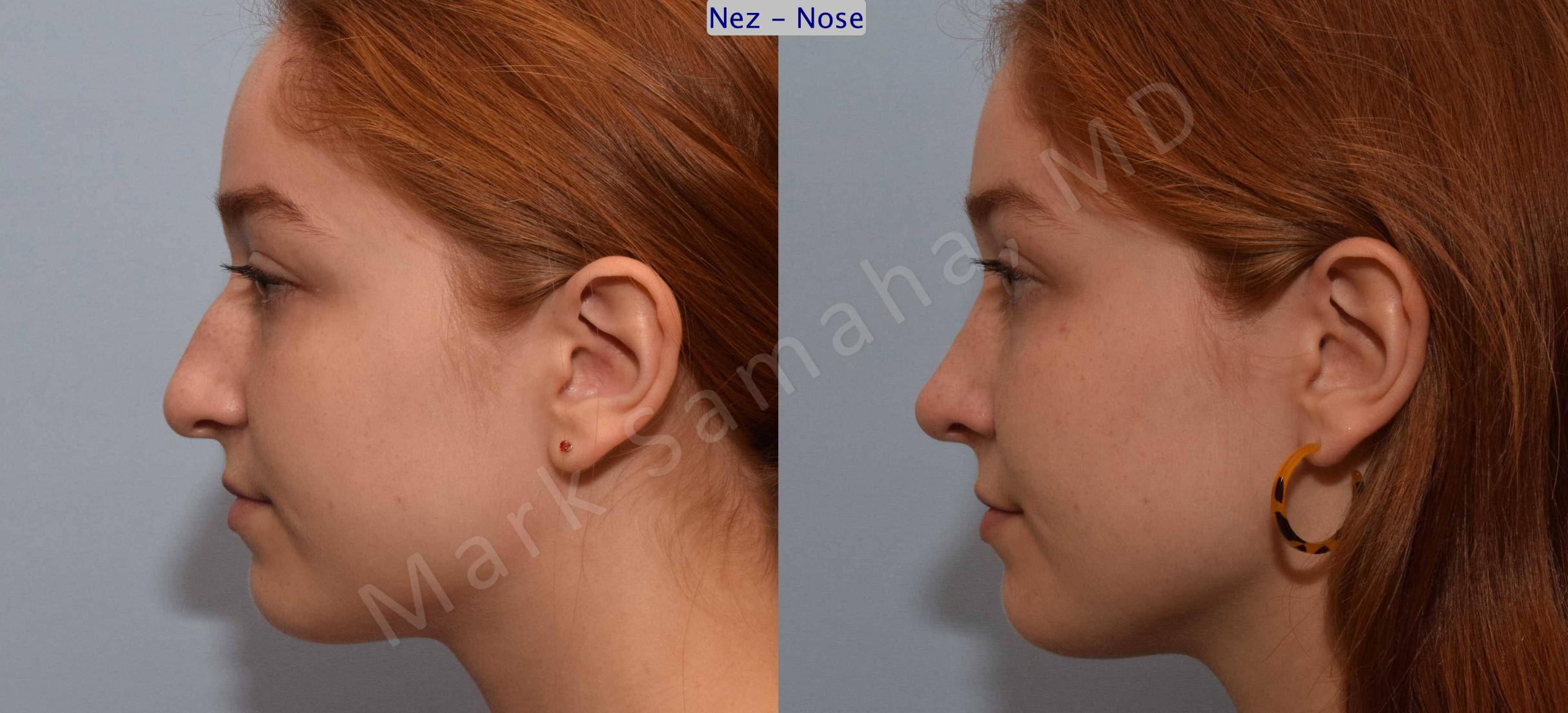 Before & After Rhinoplastie / Rhinoplasty Case 108 View #3 View in Mount Royal, QC