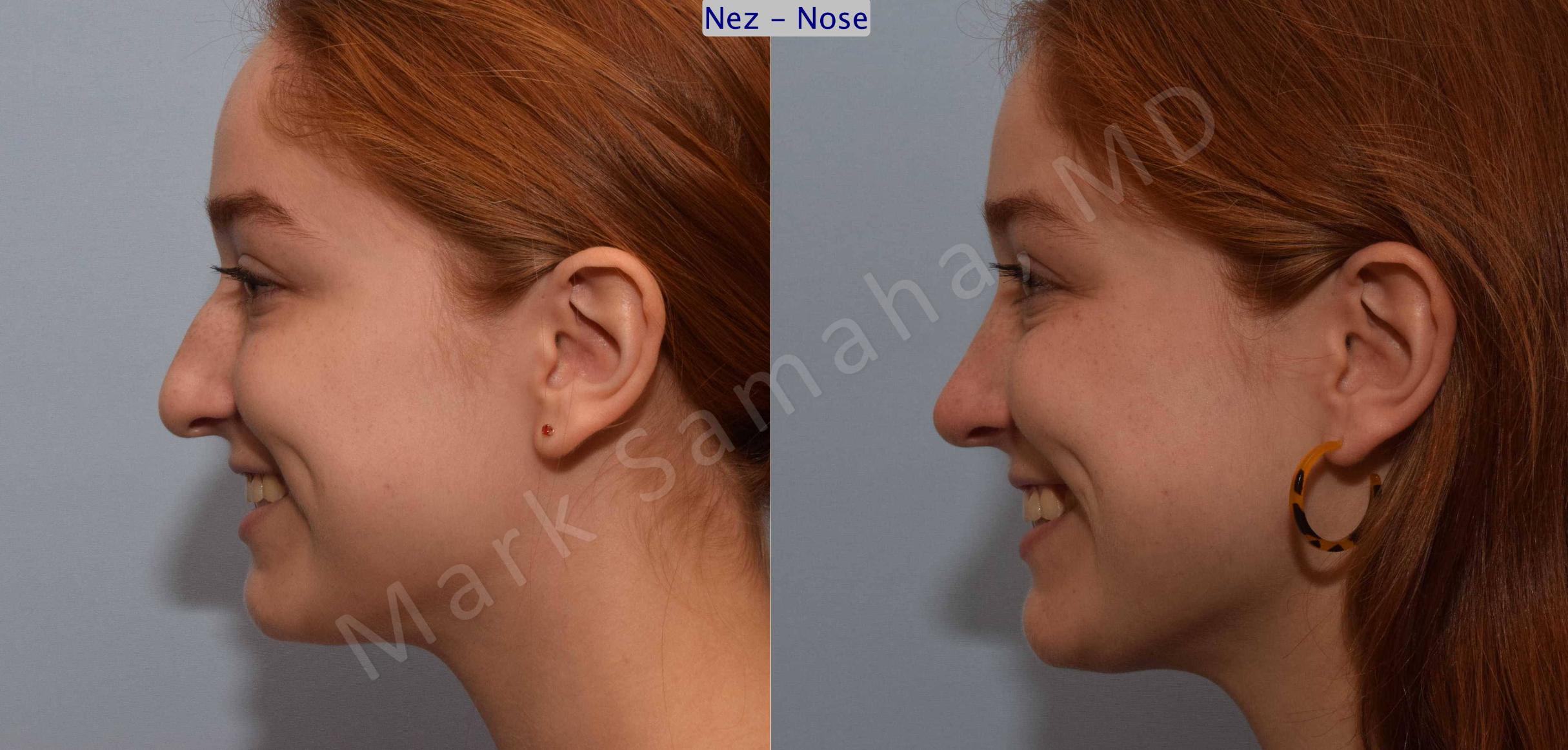 Before & After Rhinoplastie / Rhinoplasty Case 108 View #4 View in Mount Royal, QC