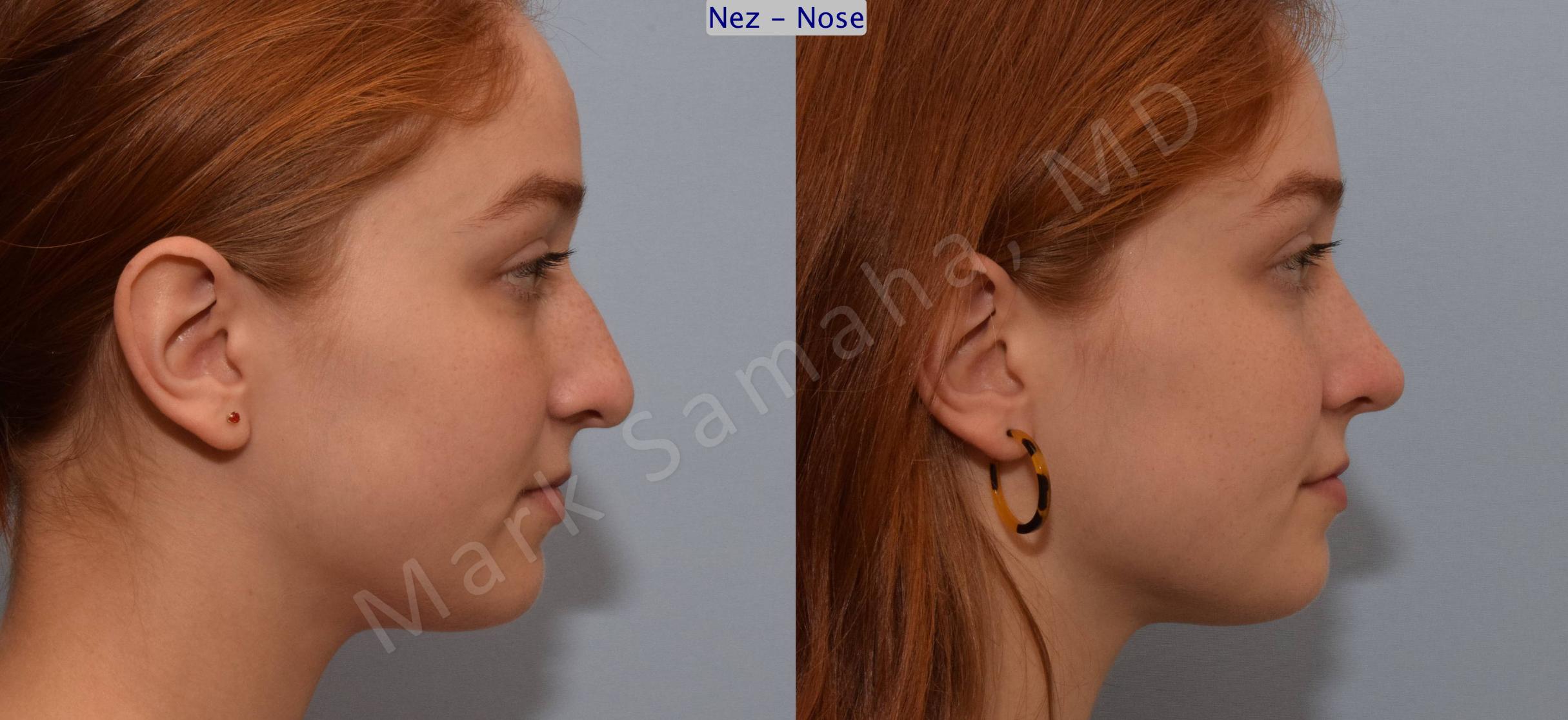 Before & After Rhinoplasty / Rhinoplastie Case 108 View #5 View in Mount Royal, QC