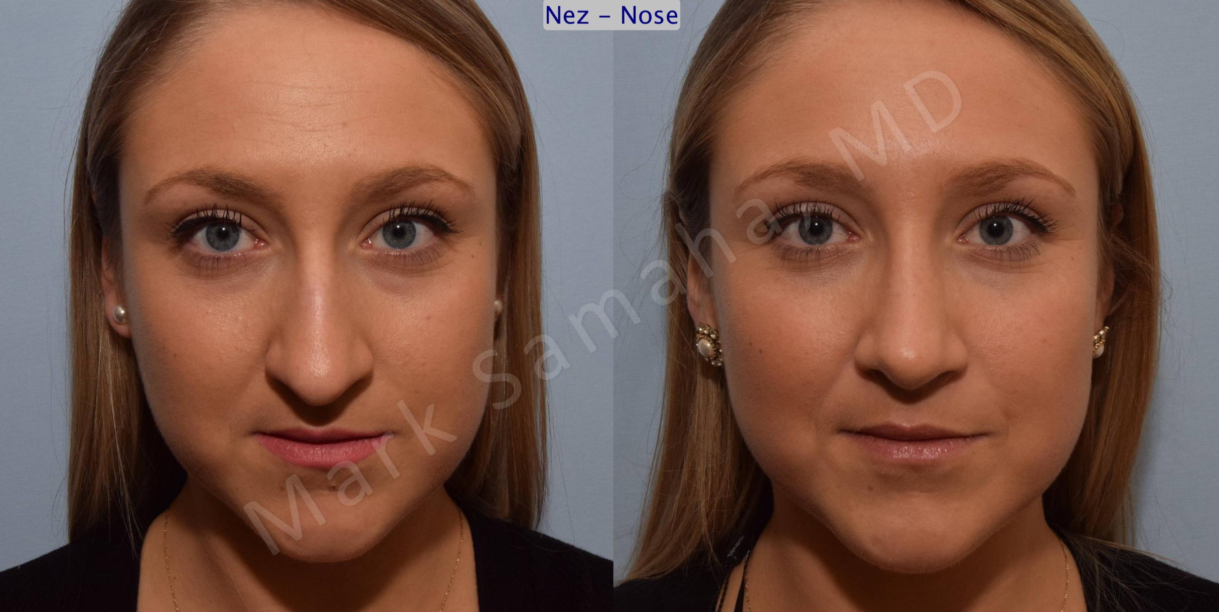 Before & After Rhinoplasty / Rhinoplastie Case 109 View #1 View in Mount Royal, QC