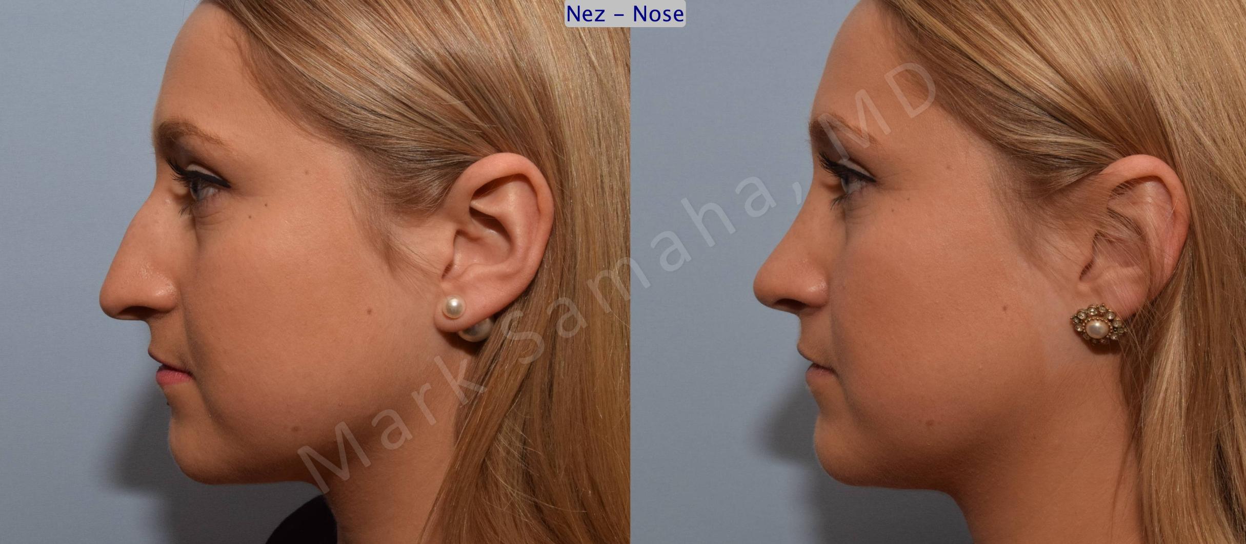 Before & After Rhinoplasty / Rhinoplastie Case 109 View #2 View in Mount Royal, QC