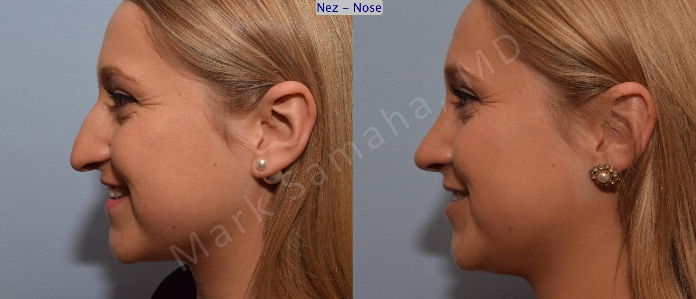 Before & After Rhinoplasty / Rhinoplastie Case 109 View #3 View in Mount Royal, QC