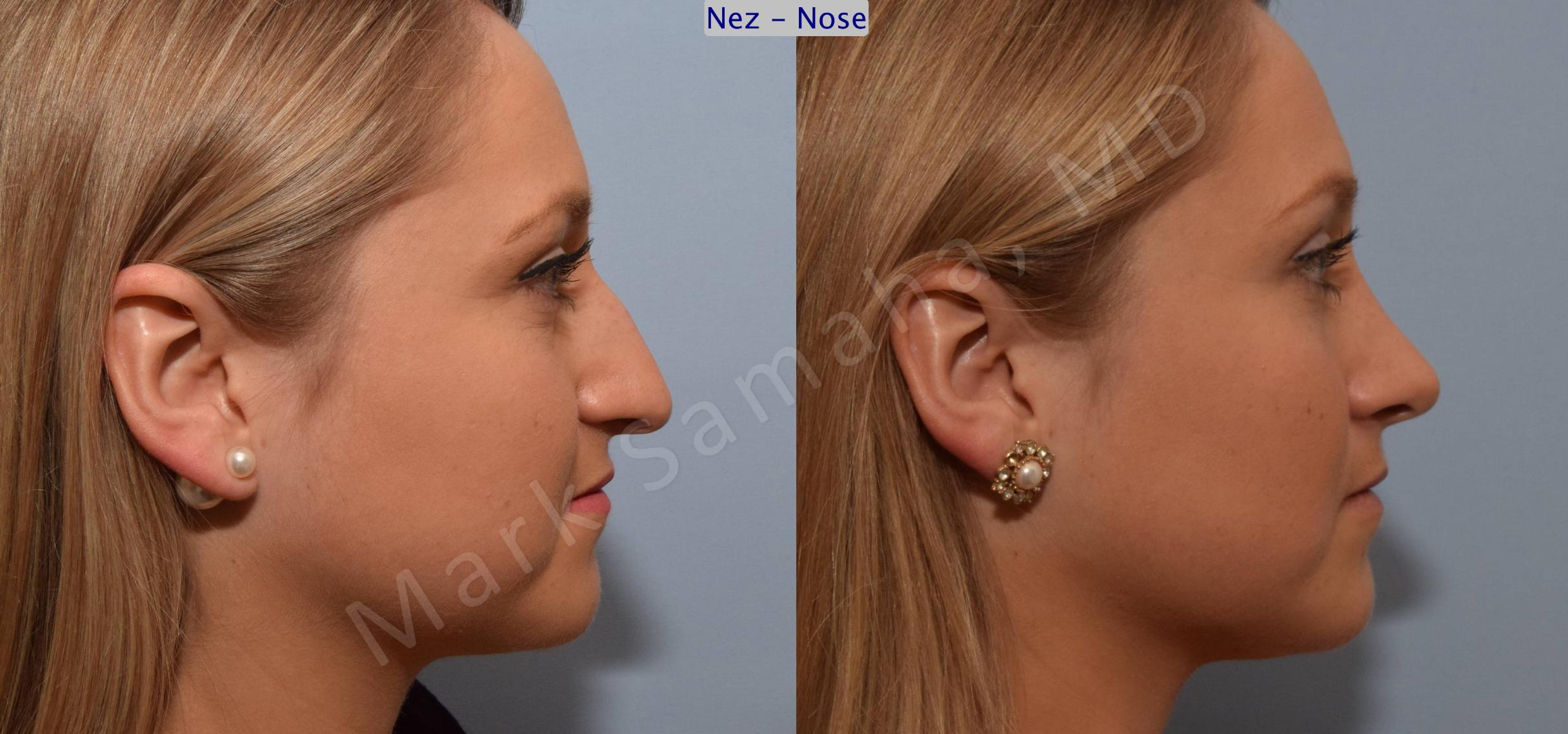 Before & After Rhinoplasty / Rhinoplastie Case 109 View #4 View in Mount Royal, QC
