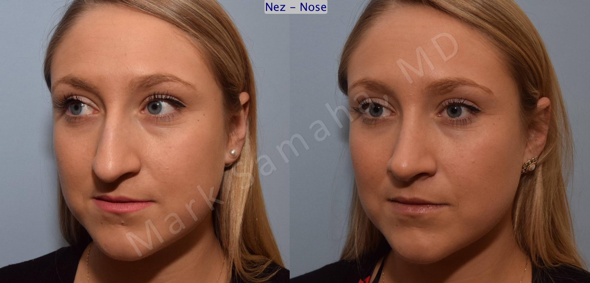 Before & After Rhinoplasty / Rhinoplastie Case 109 View #6 View in Mount Royal, QC