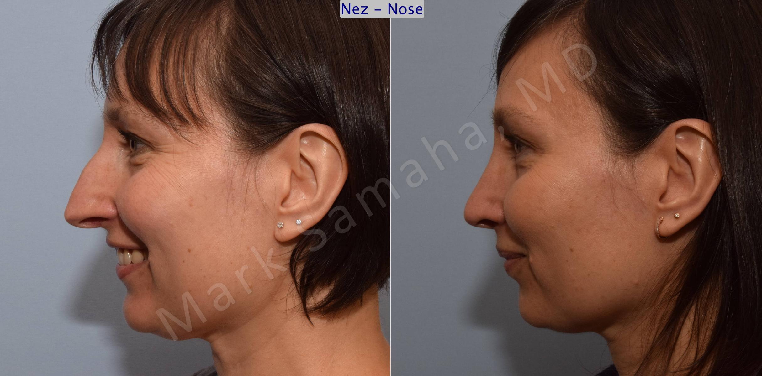 Before & After Rhinoplasty / Rhinoplastie Case 110 View #3 View in Mount Royal, QC