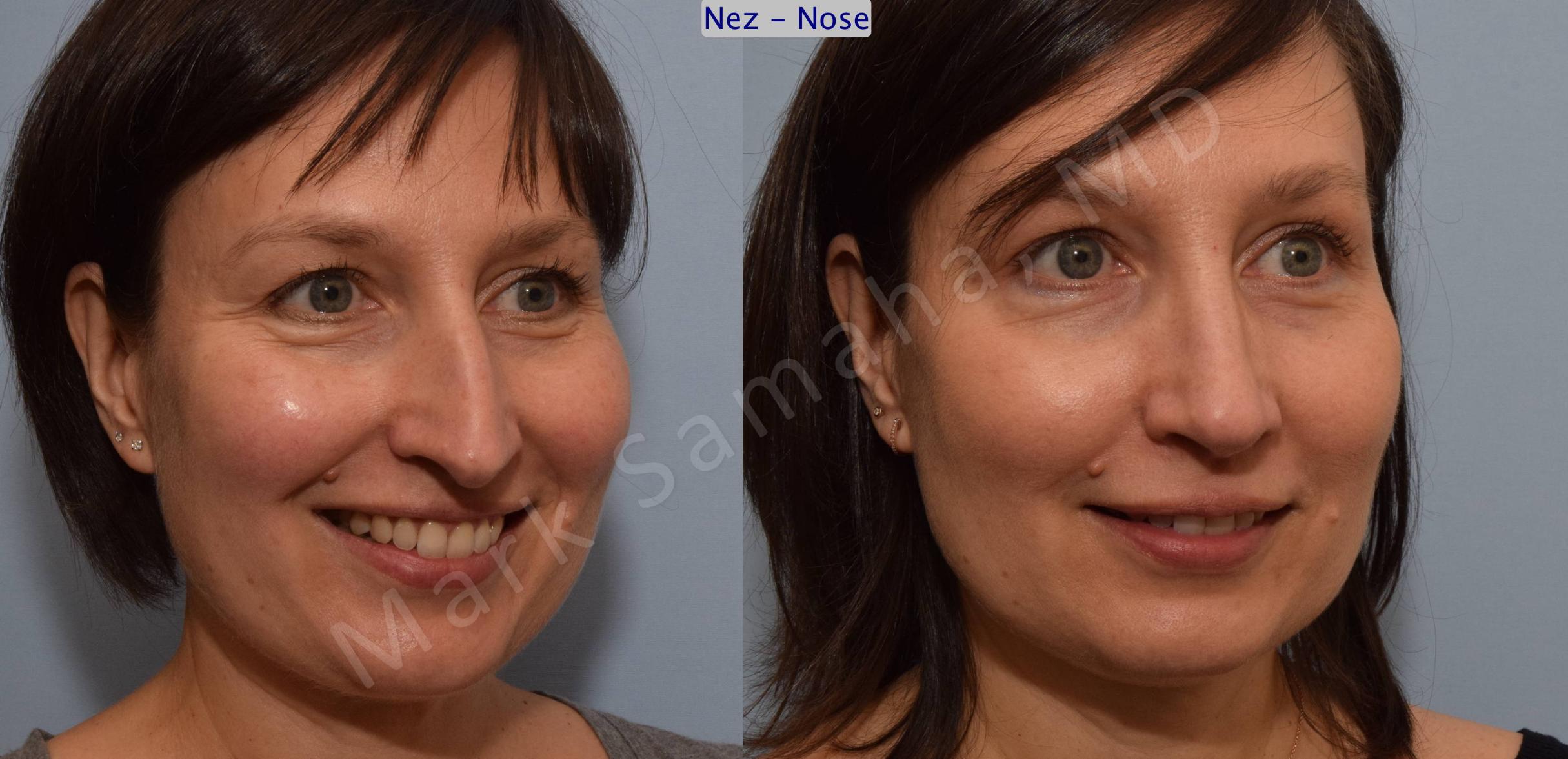 Before & After Rhinoplasty / Rhinoplastie Case 110 View #9 View in Mount Royal, QC
