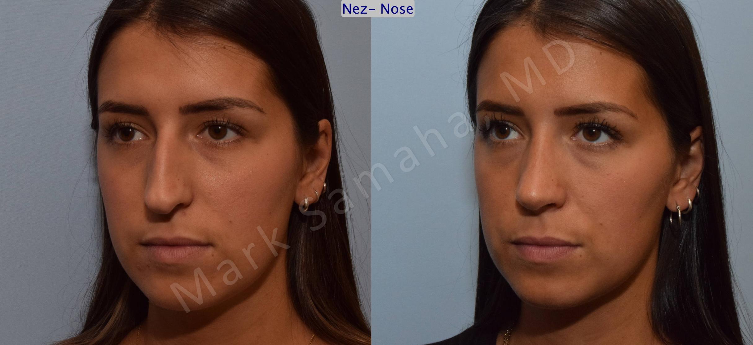 Before & After Rhinoplasty / Rhinoplastie Case 114 View #3 View in Mount Royal, QC