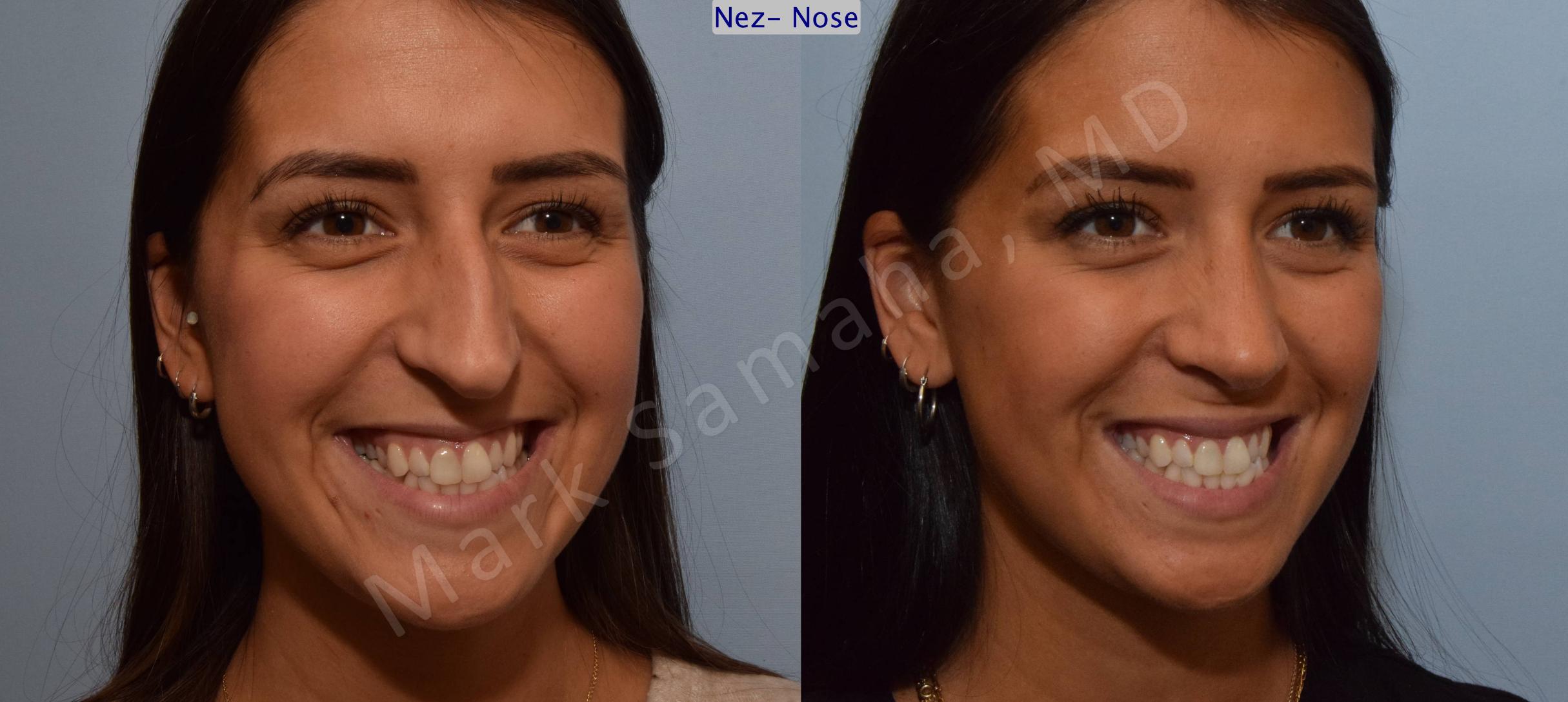 Before & After Rhinoplasty / Rhinoplastie Case 114 View #4 View in Mount Royal, QC