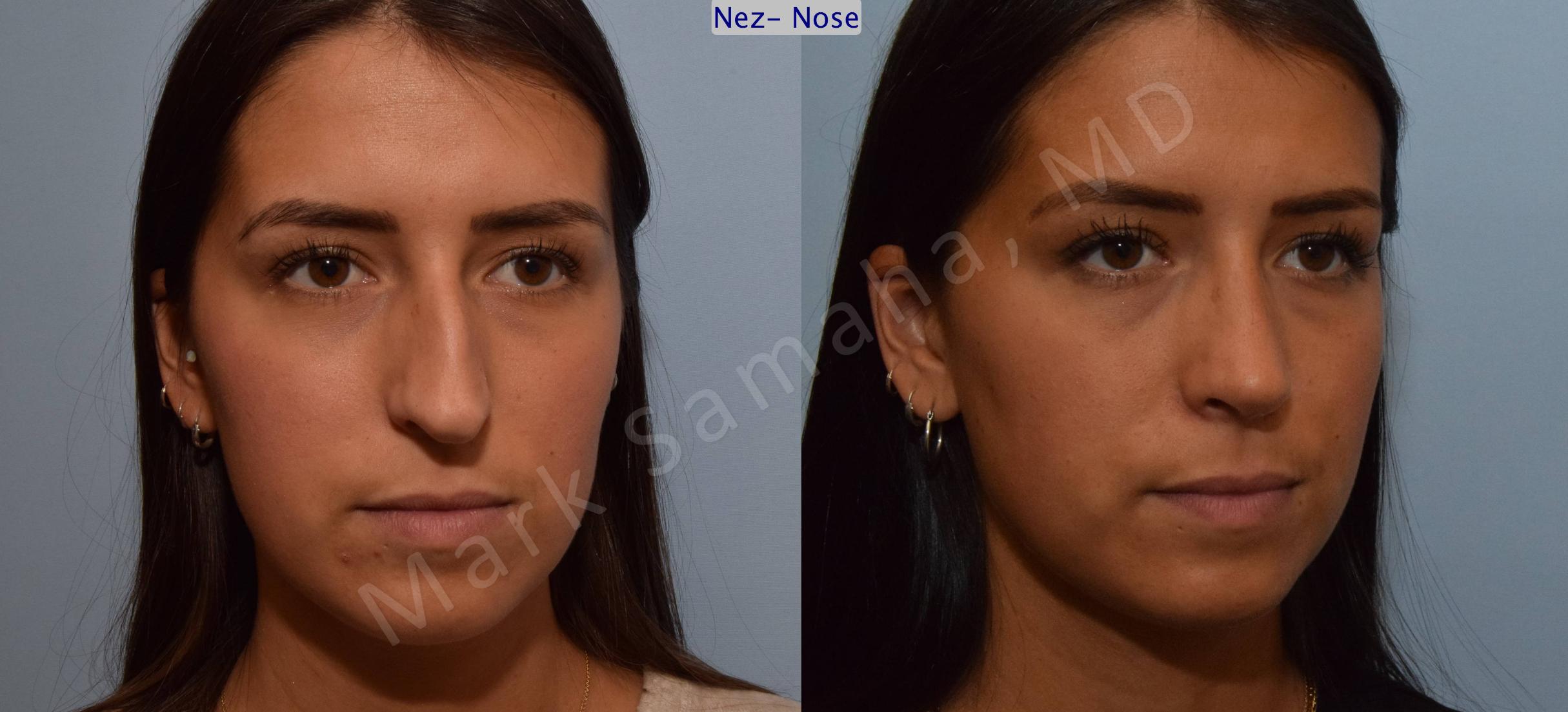 Before & After Rhinoplasty / Rhinoplastie Case 114 View #5 View in Mount Royal, QC