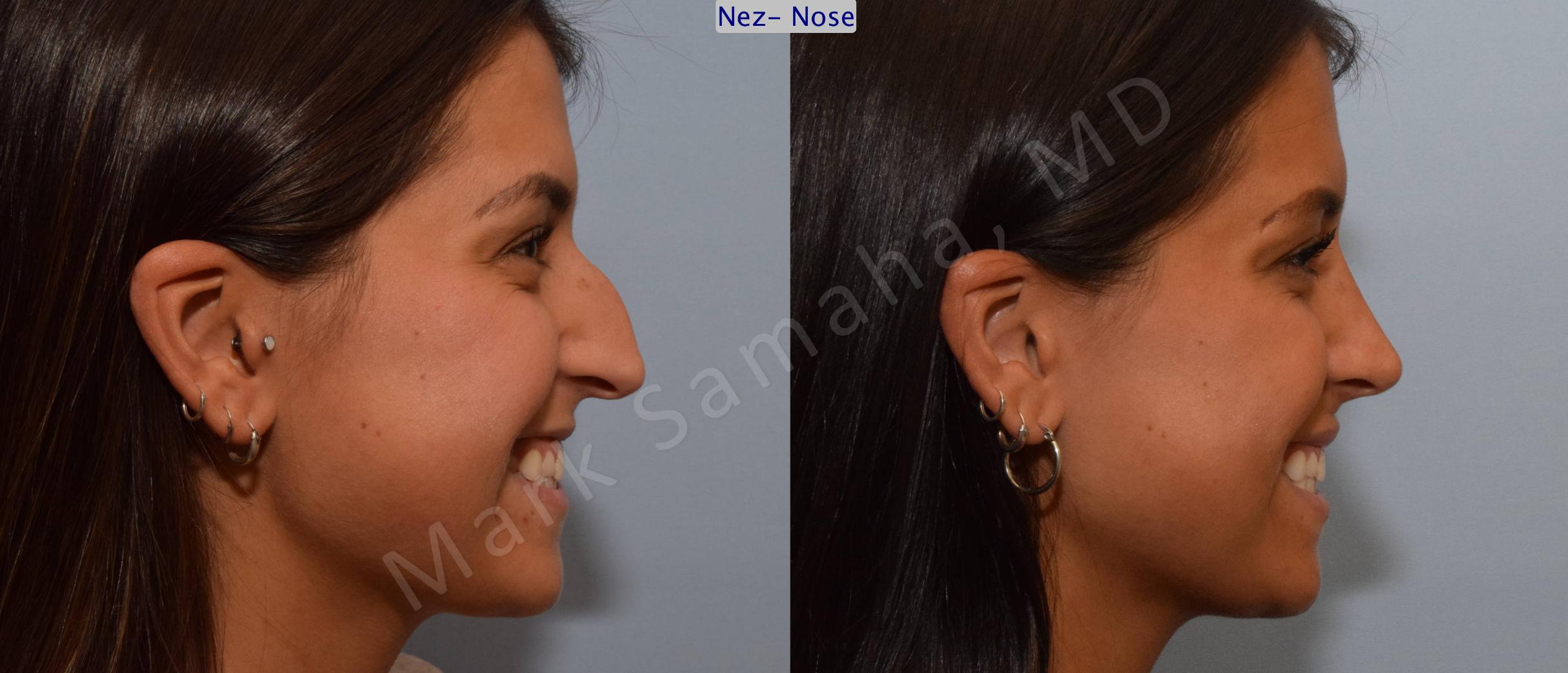 Before & After Rhinoplasty / Rhinoplastie Case 114 View #8 View in Mount Royal, QC