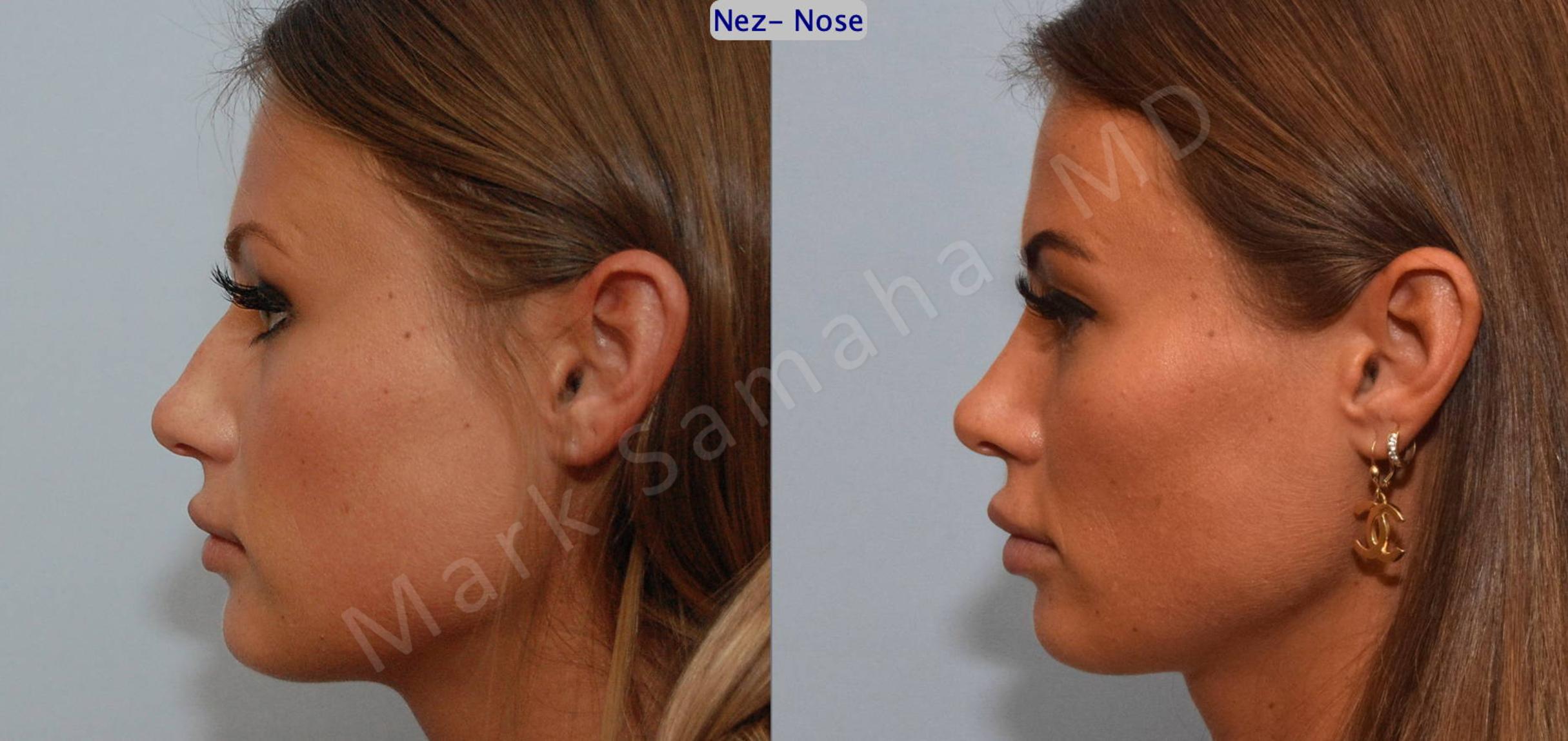 Before & After Rhinoplasty / Rhinoplastie Case 123 View #2 View in Mount Royal, QC