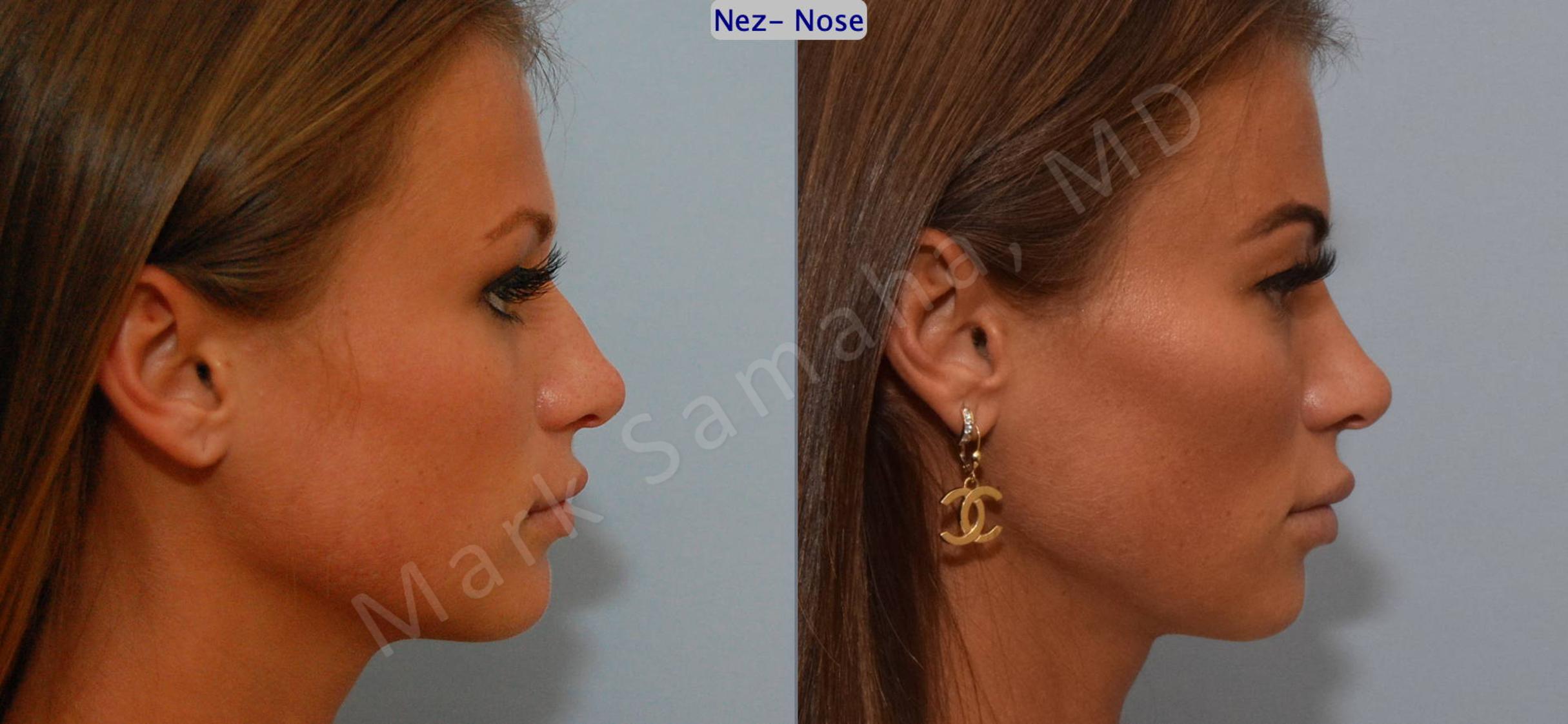 Before & After Rhinoplasty / Rhinoplastie Case 123 View #3 View in Mount Royal, QC