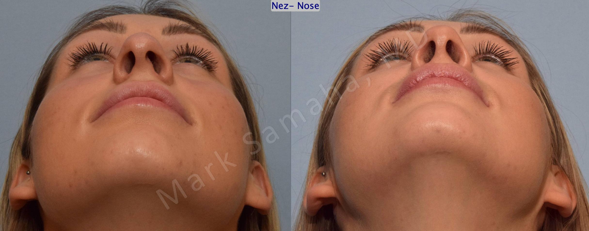 Before & After Rhinoplasty / Rhinoplastie Case 125 View #2 View in Mount Royal, QC