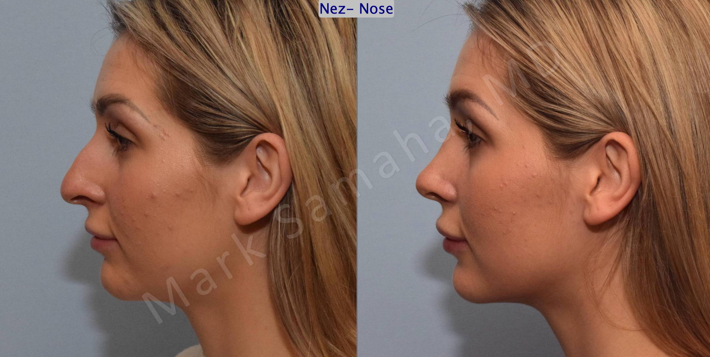 Before & After Rhinoplastie / Rhinoplasty Case 125 View #3 View in Mount Royal, QC