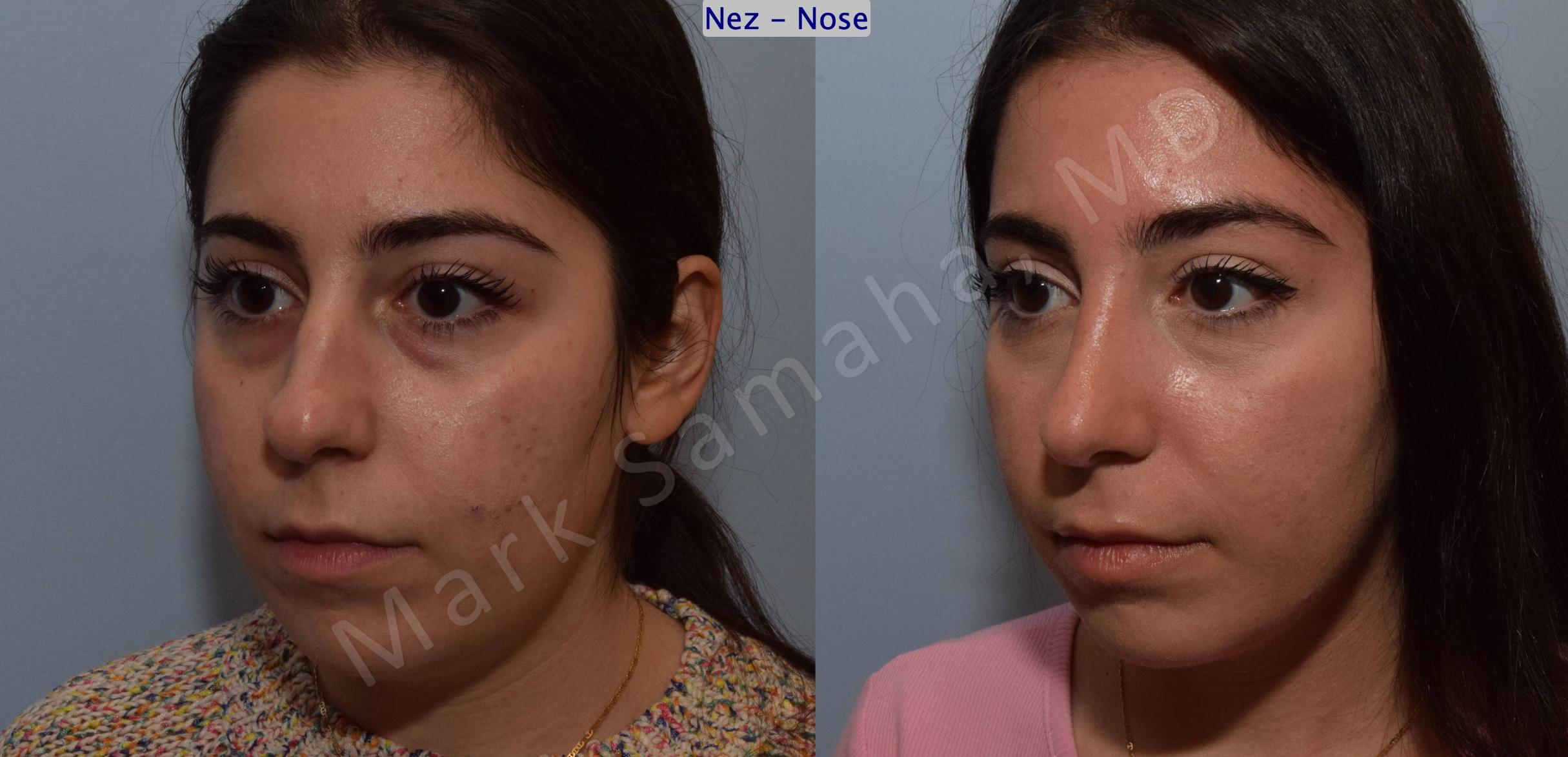 Before & After Rhinoplasty / Rhinoplastie Case 139 Left Oblique View in Mount Royal, QC