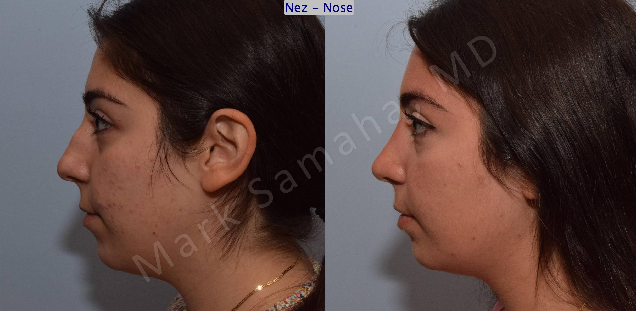 Before & After Rhinoplasty / Rhinoplastie Case 139 Left Side View in Mount Royal, QC