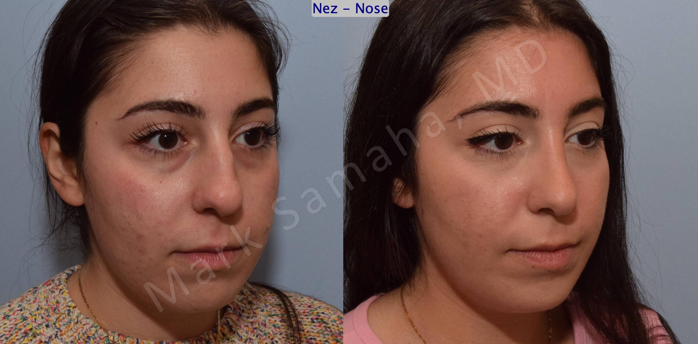 Before & After Rhinoplasty / Rhinoplastie Case 139 Right Oblique View in Mount Royal, QC