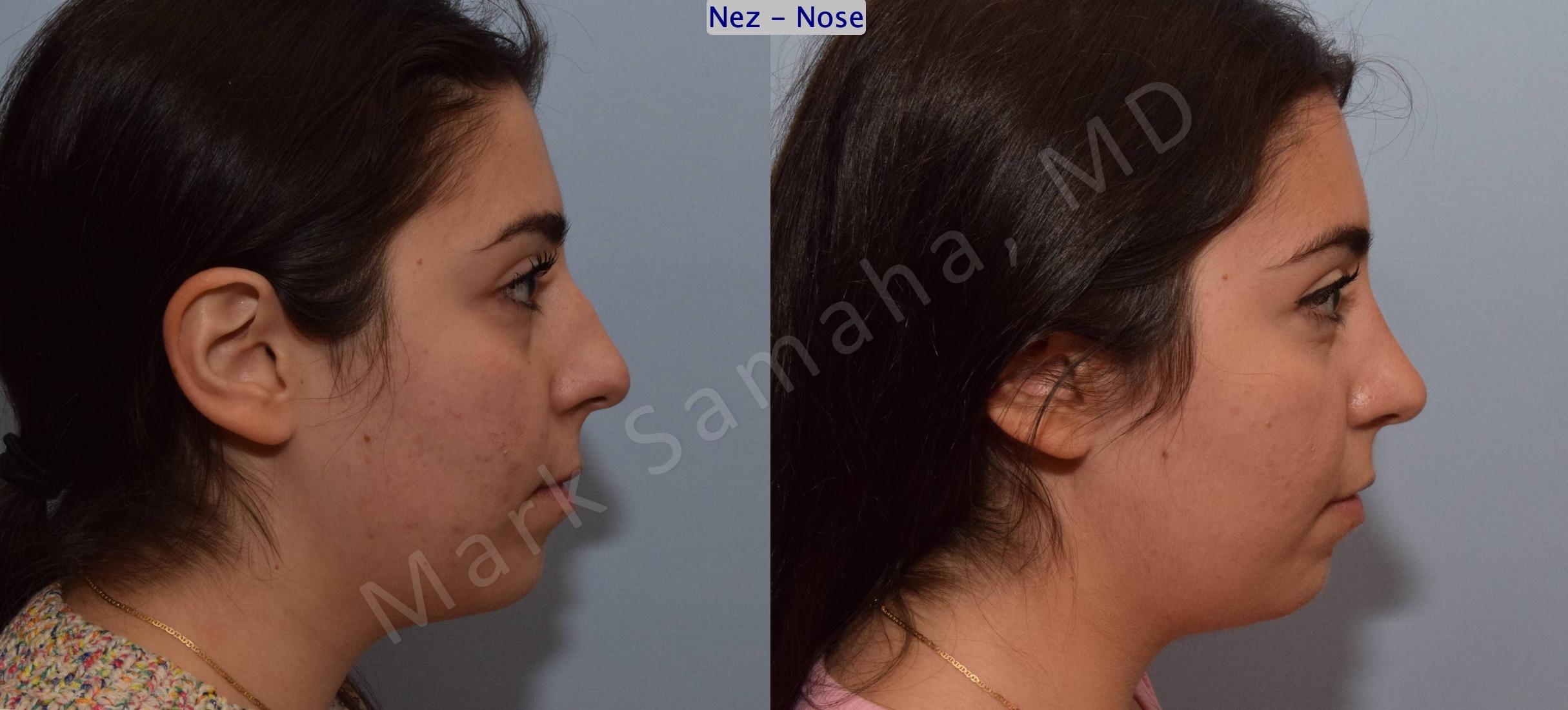 Before & After Rhinoplasty / Rhinoplastie Case 139 Right Side View in Mount Royal, QC