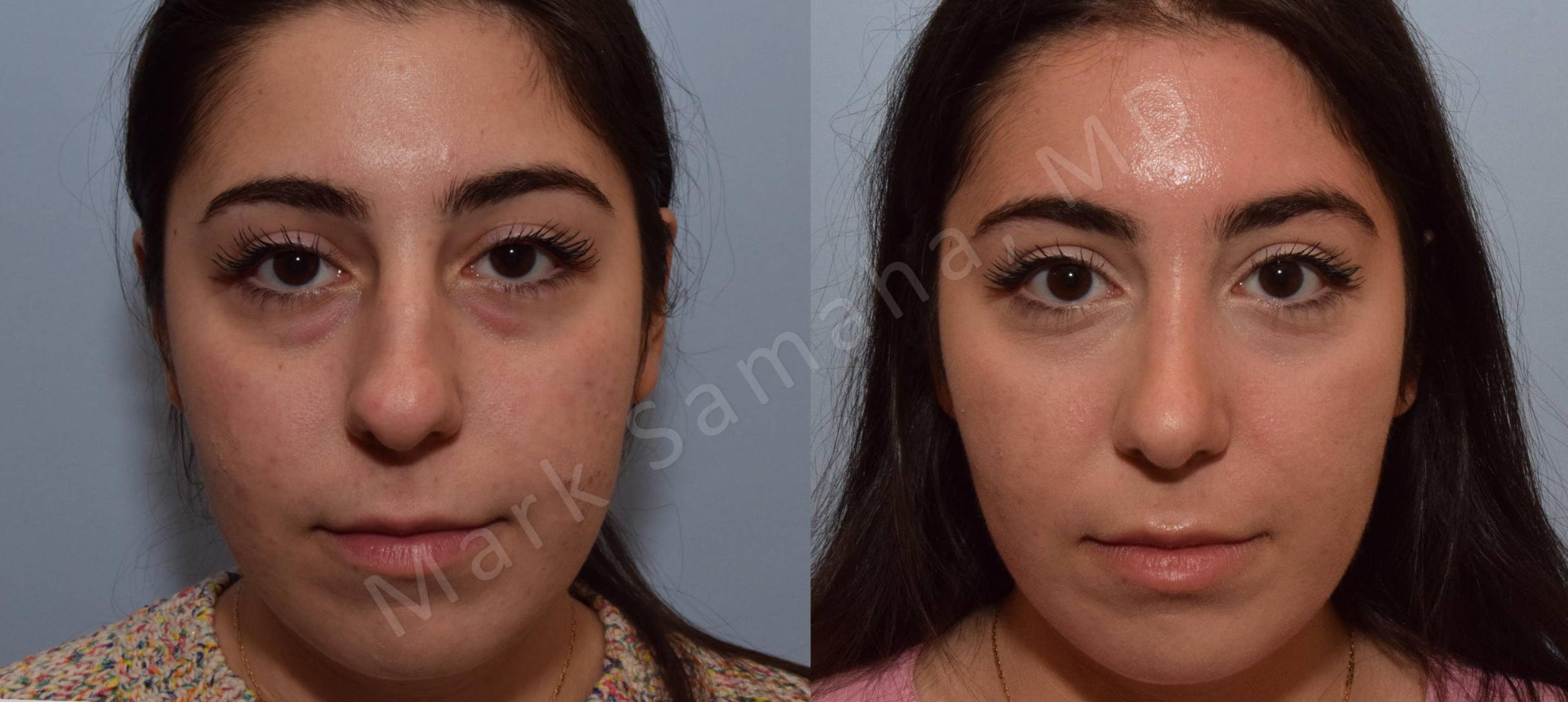 Before & After Rhinoplasty / Rhinoplastie Case 139 View #1 View in Mount Royal, QC