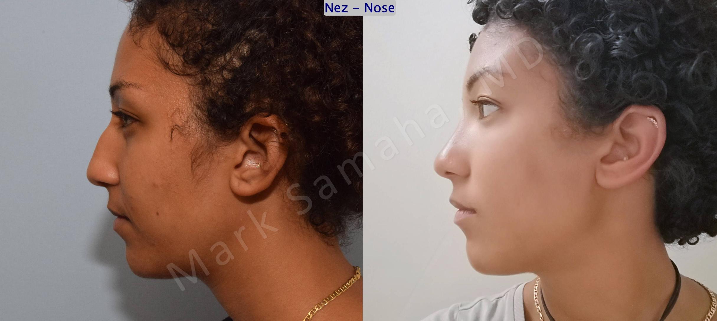 Before & After Rhinoplasty / Rhinoplastie Case 141 Left Side View in Mount Royal, QC