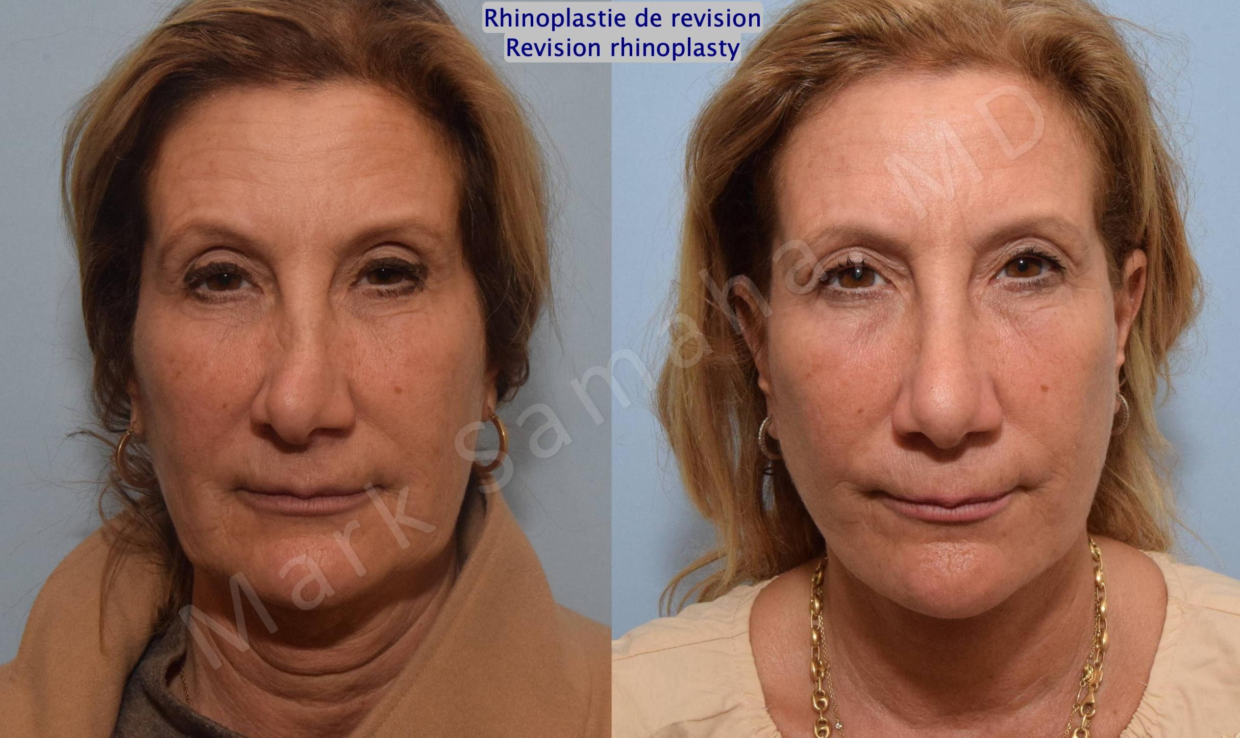 Before & After Rhinoplastie / Rhinoplasty Case 181 Front View in Mount Royal, QC
