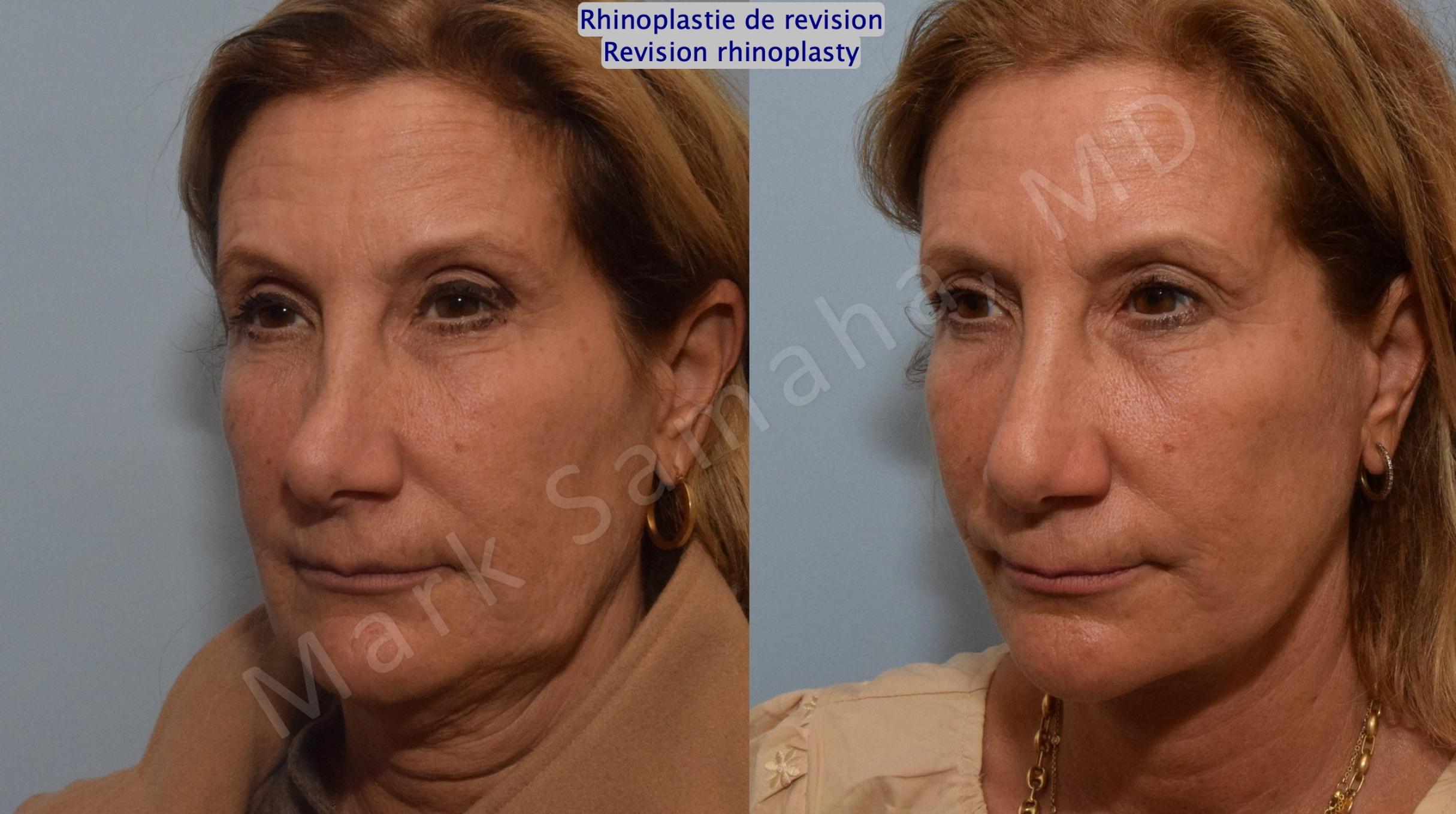 Before & After Rhinoplasty / Rhinoplastie Case 181 Left Oblique View in Mount Royal, QC