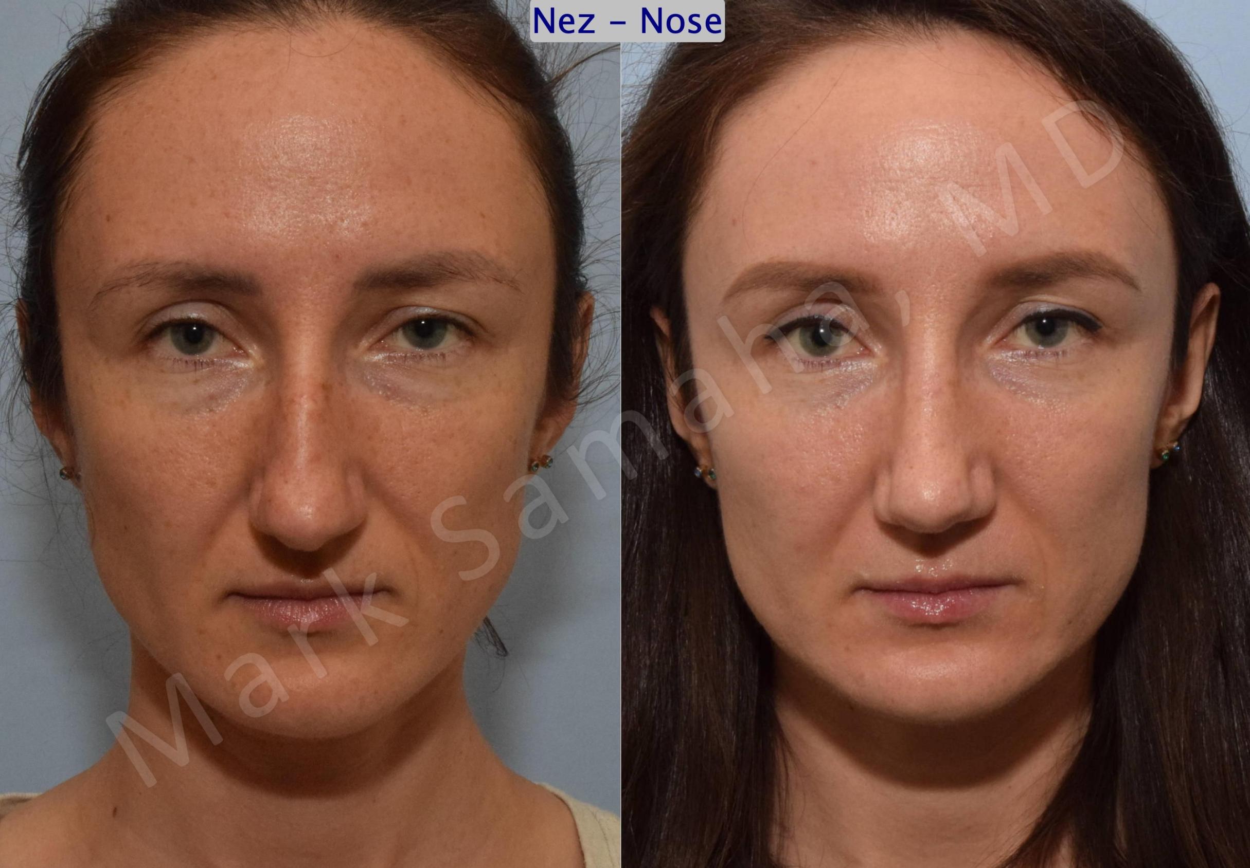 Before & After Rhinoplasty / Rhinoplastie Case 182 Front View in Mount Royal, QC