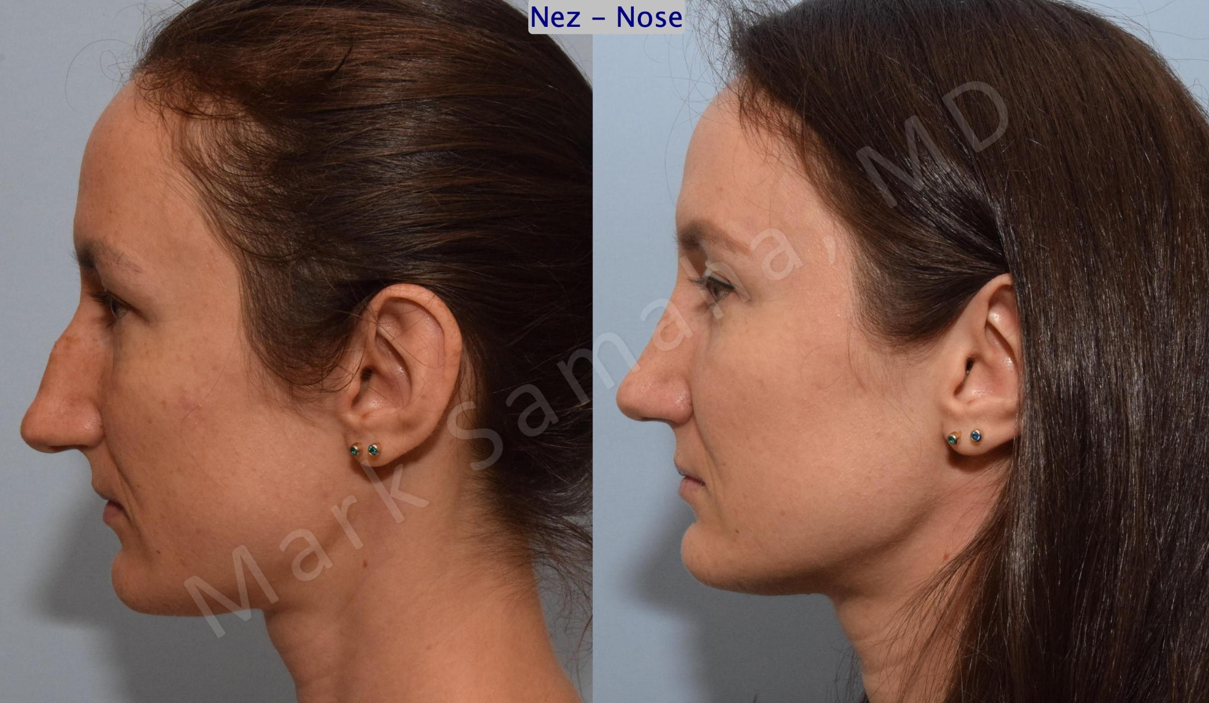 Before & After Rhinoplasty / Rhinoplastie Case 182 Left Side View in Mount Royal, QC