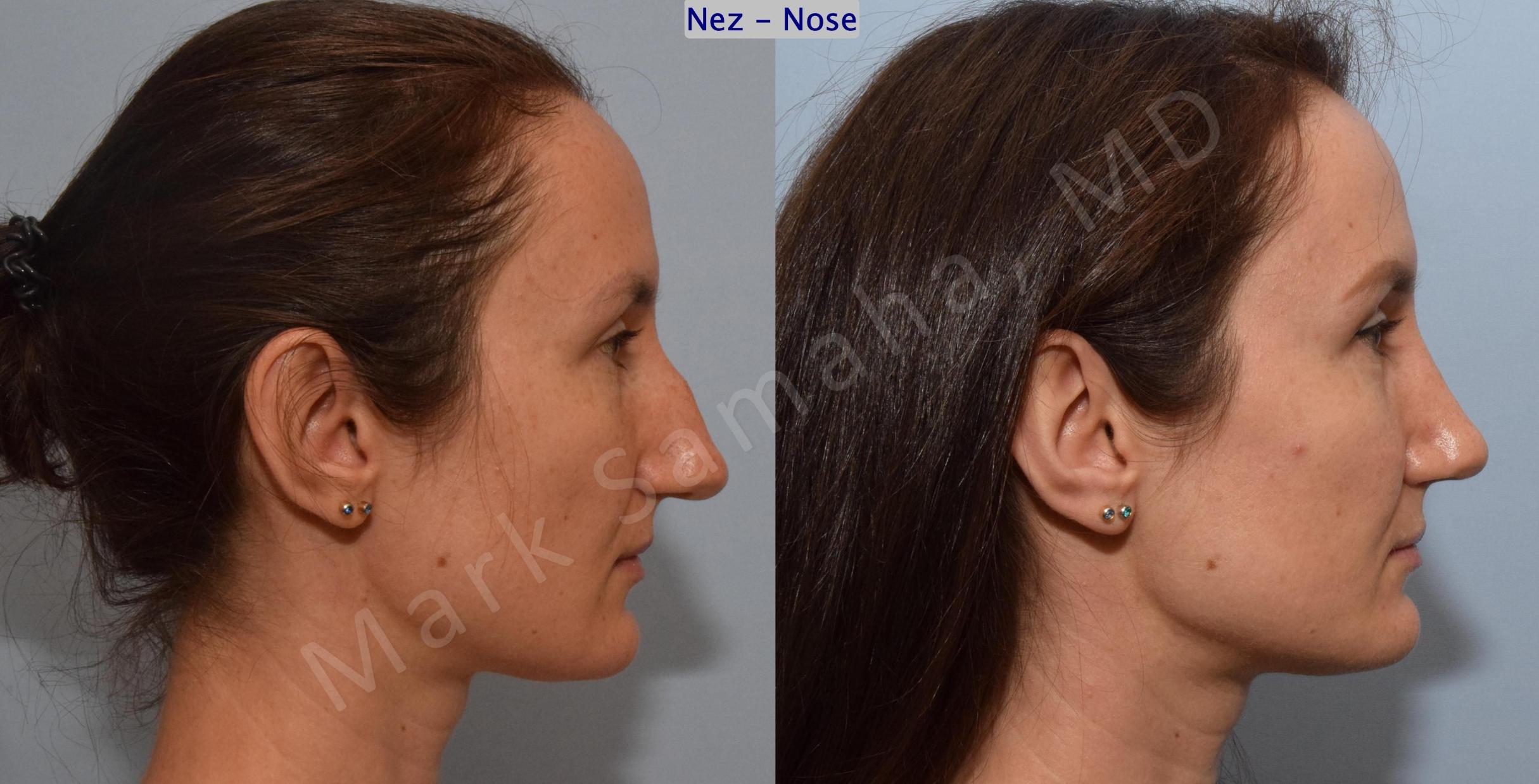 Before & After Rhinoplasty / Rhinoplastie Case 182 Right Side View in Mount Royal, QC